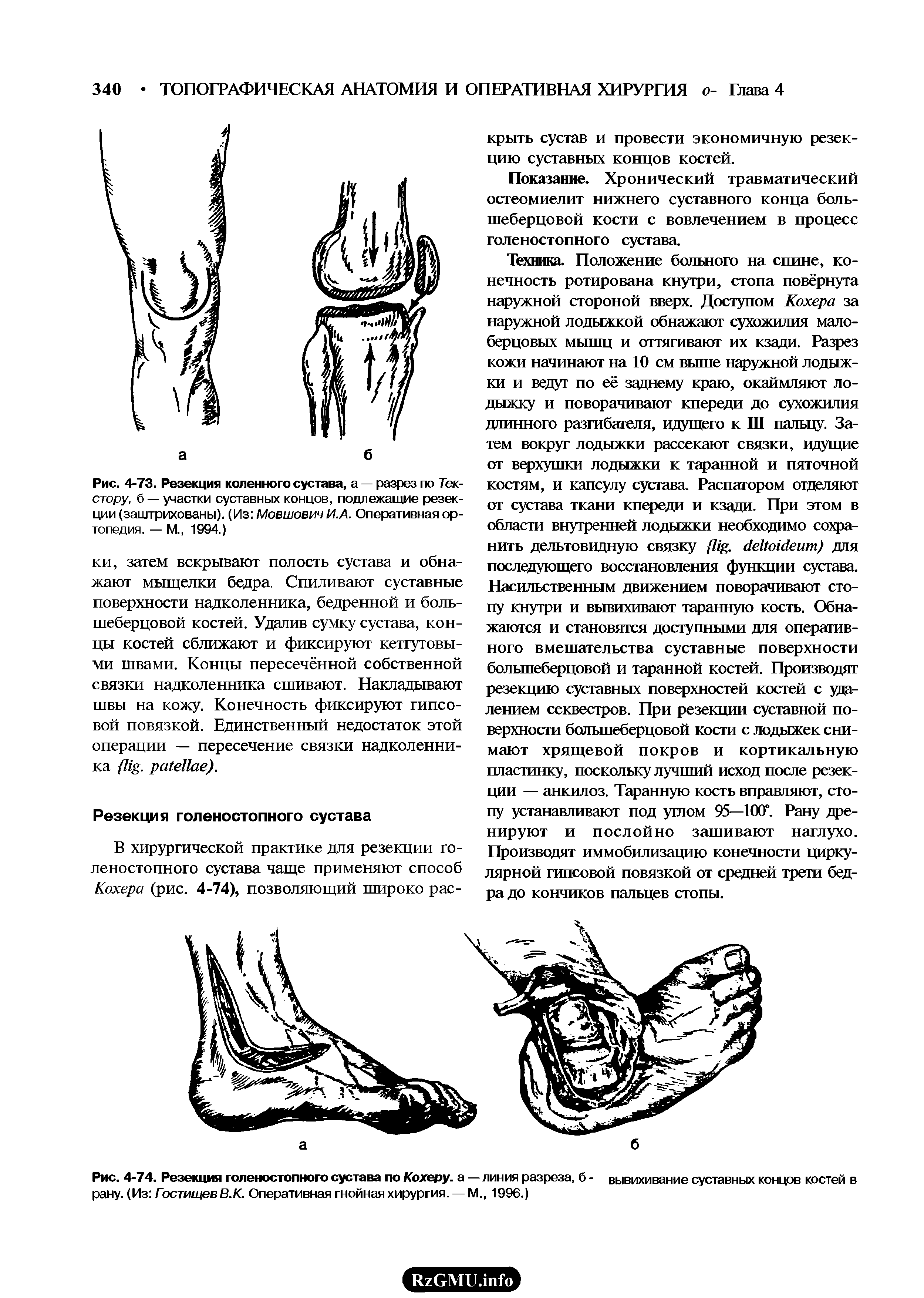 Рис. 4-74. Резекция голеностопного сустава по Кохеру, а — линия разреза, б - вывихивание суставных концов костей в рану. (Из ГостищевВ.К. Оперативная гнойная хирургия. — М., 1996.)...