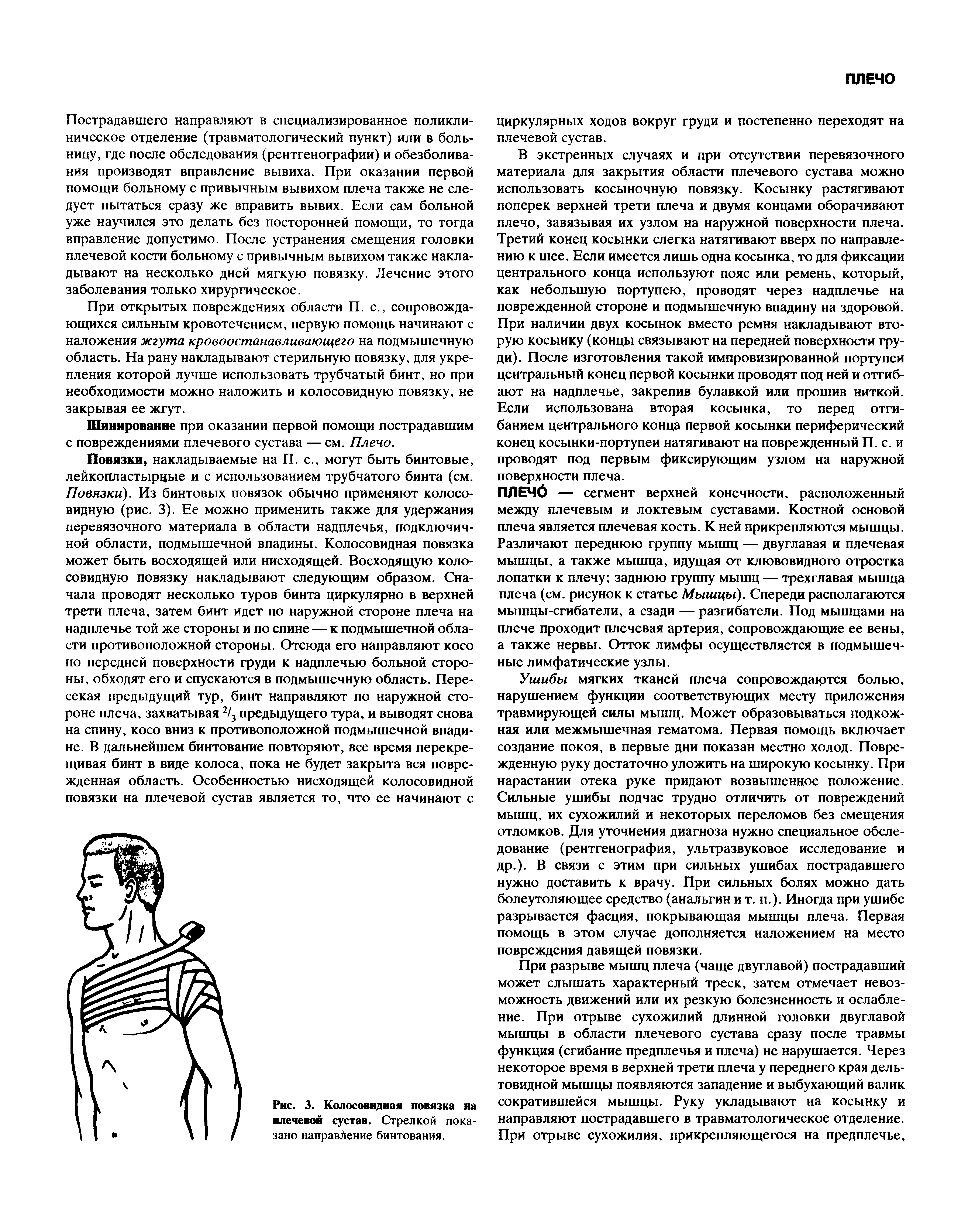 Рис. 3. Колосовидная повязка на плечевой сустав. Стрелкой показано направление бинтования.