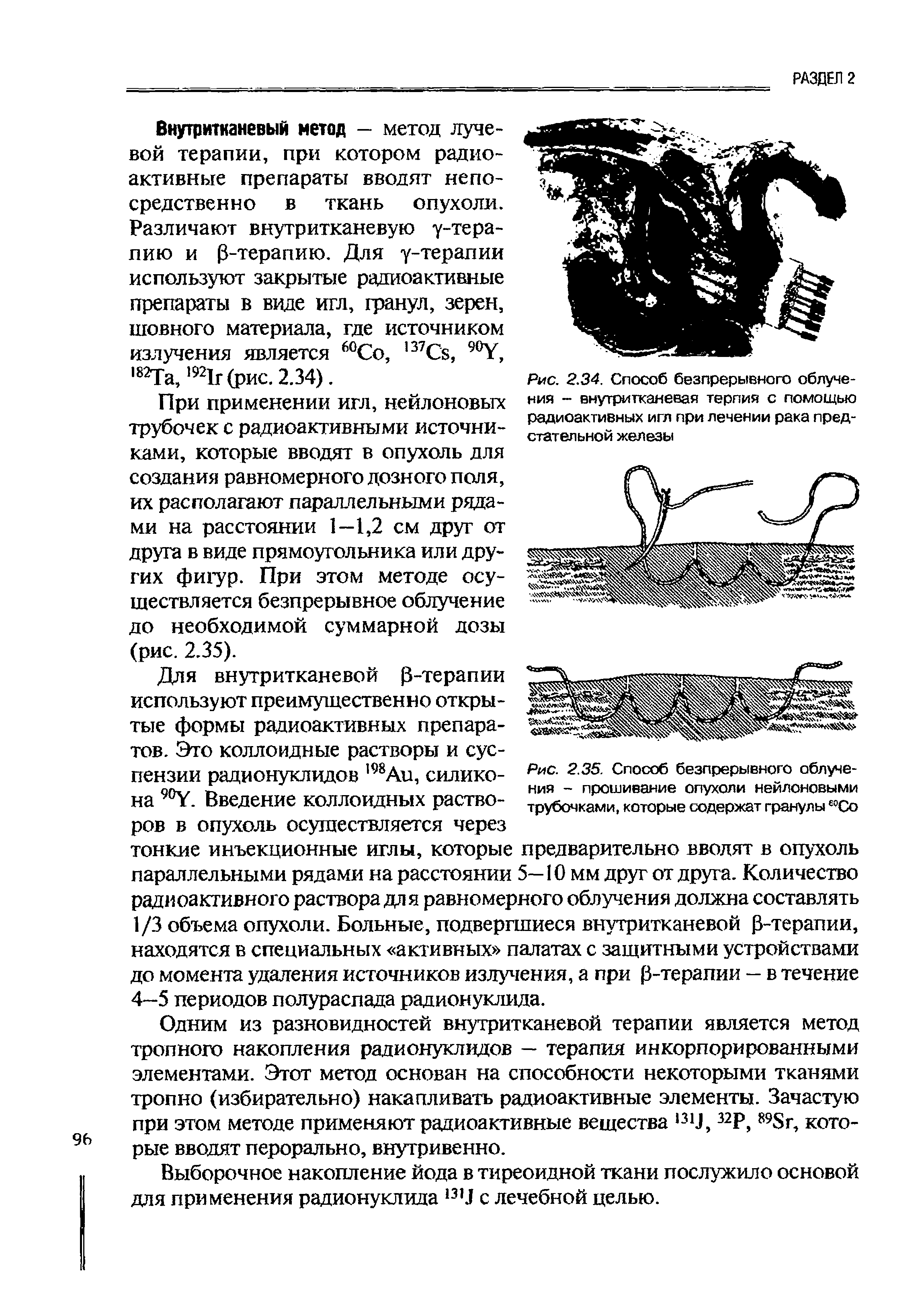 Рис. 2.34. Способ безпрерывного облучения - внутритканевая терпия с помощью радиоактивных игл при лечении рака предстательной железы...