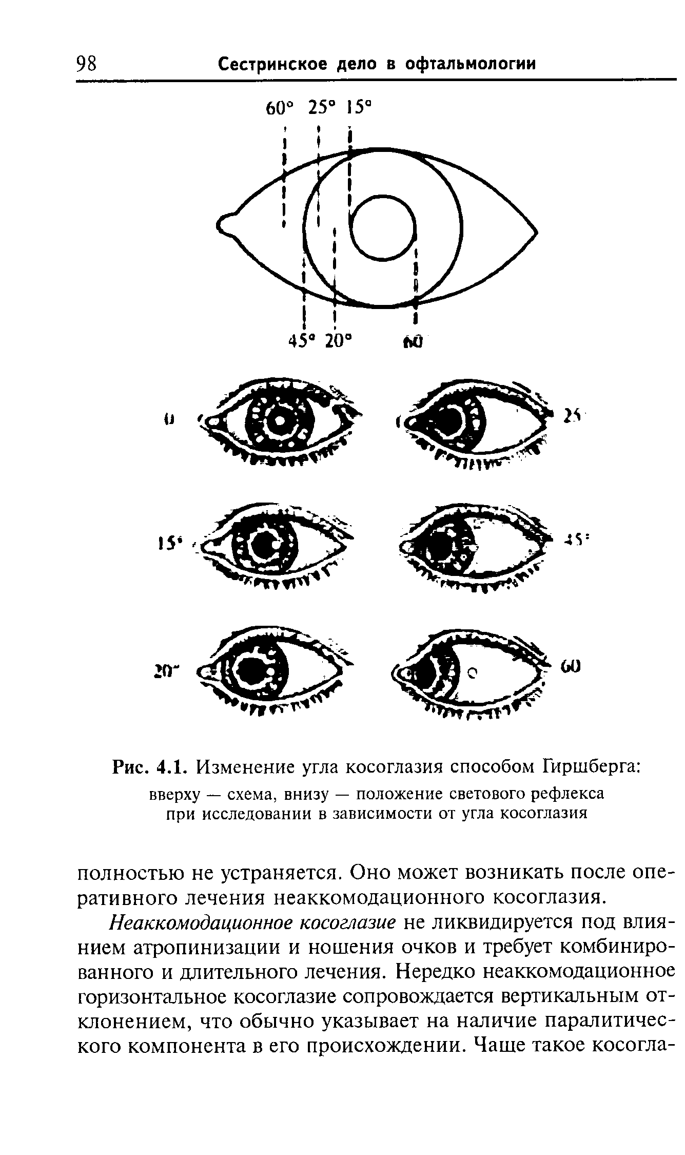 Рис. 4.1. Изменение угла косоглазия способом Гиршберга вверху — схема, внизу — положение светового рефлекса при исследовании в зависимости от угла косоглазия...