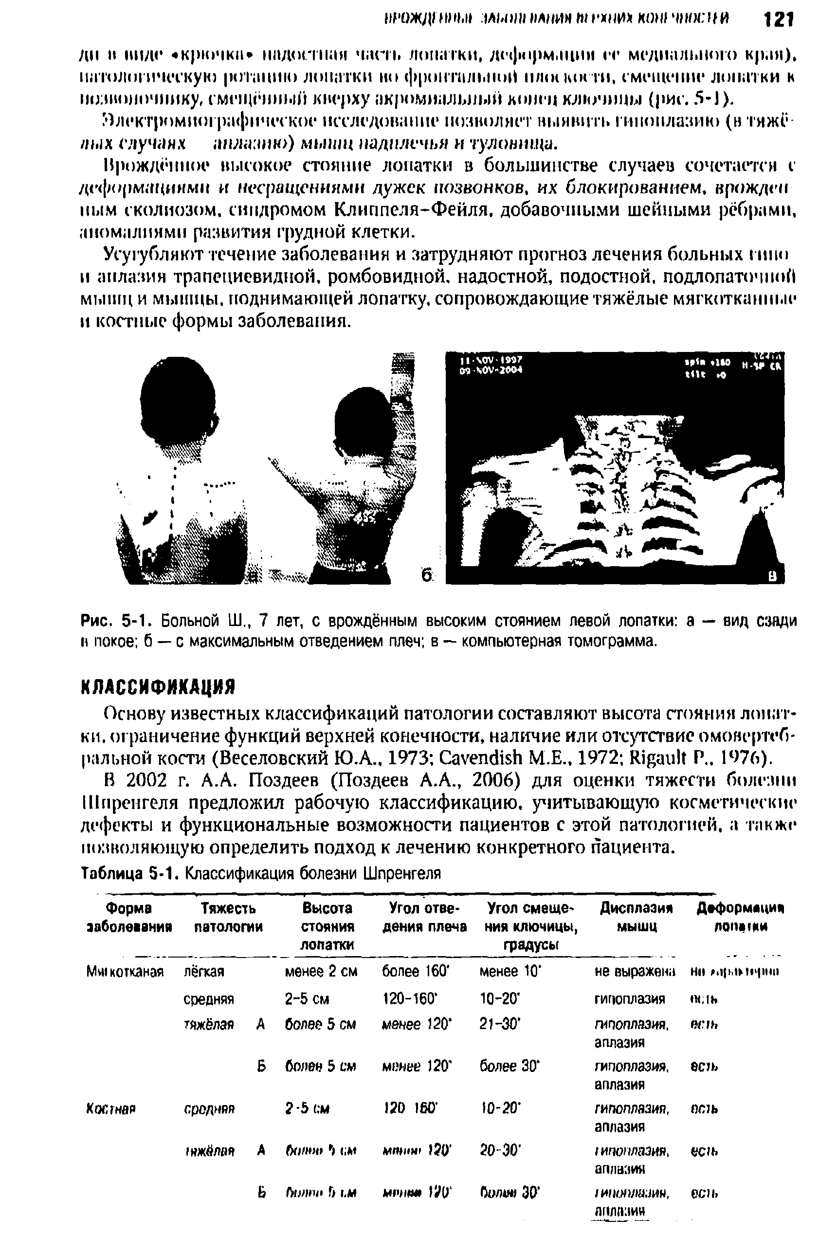 Рис. 5-1. Больной Ш., 7 лет, с врождённым высоким стоянием левой лопатки а — вид сзади н покое б — с максимальным отведением плеч в — компьютерная томограмма.