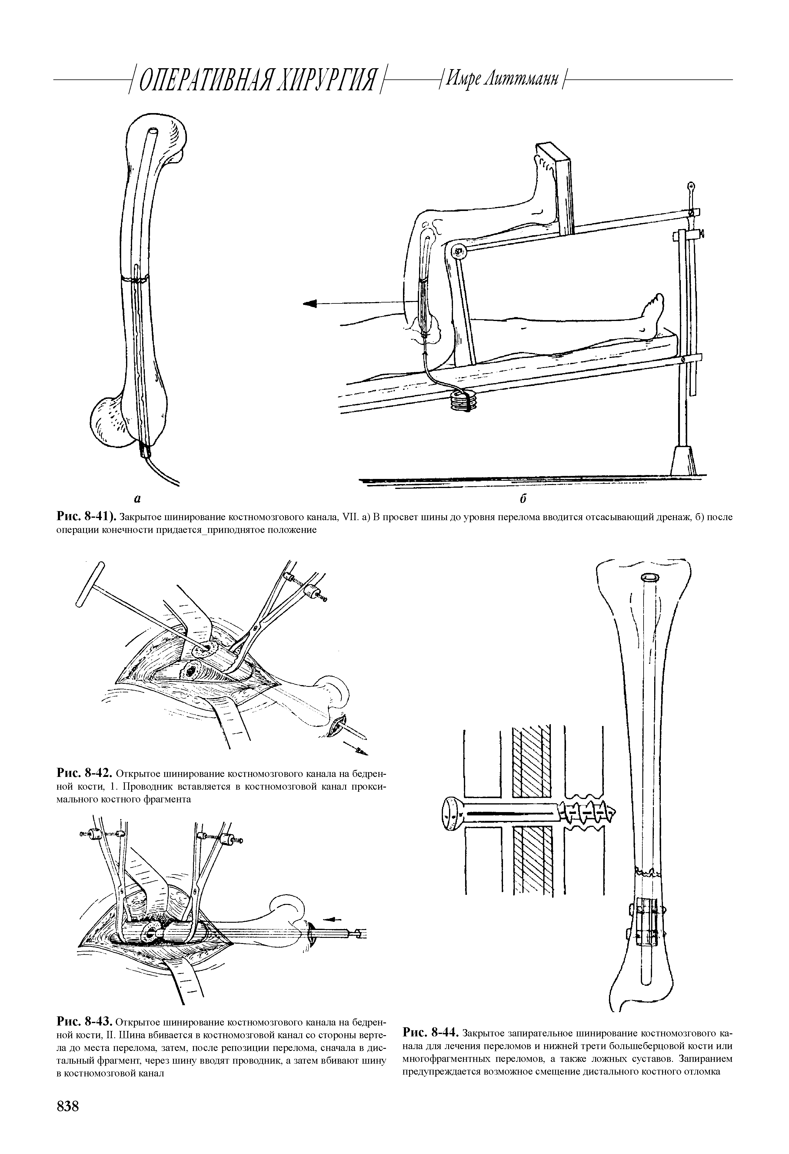 Рис. 8-43. Открытое шинирование костномозгового канала на бедренной кости, II. Шина вбивается в костномозговой канал со стороны вертела до места перелома, затем, после репозиции перелома, сначала в дистальный фрагмент, через шину вводят проводник, а затем вбивают шину в костномозговой канал...