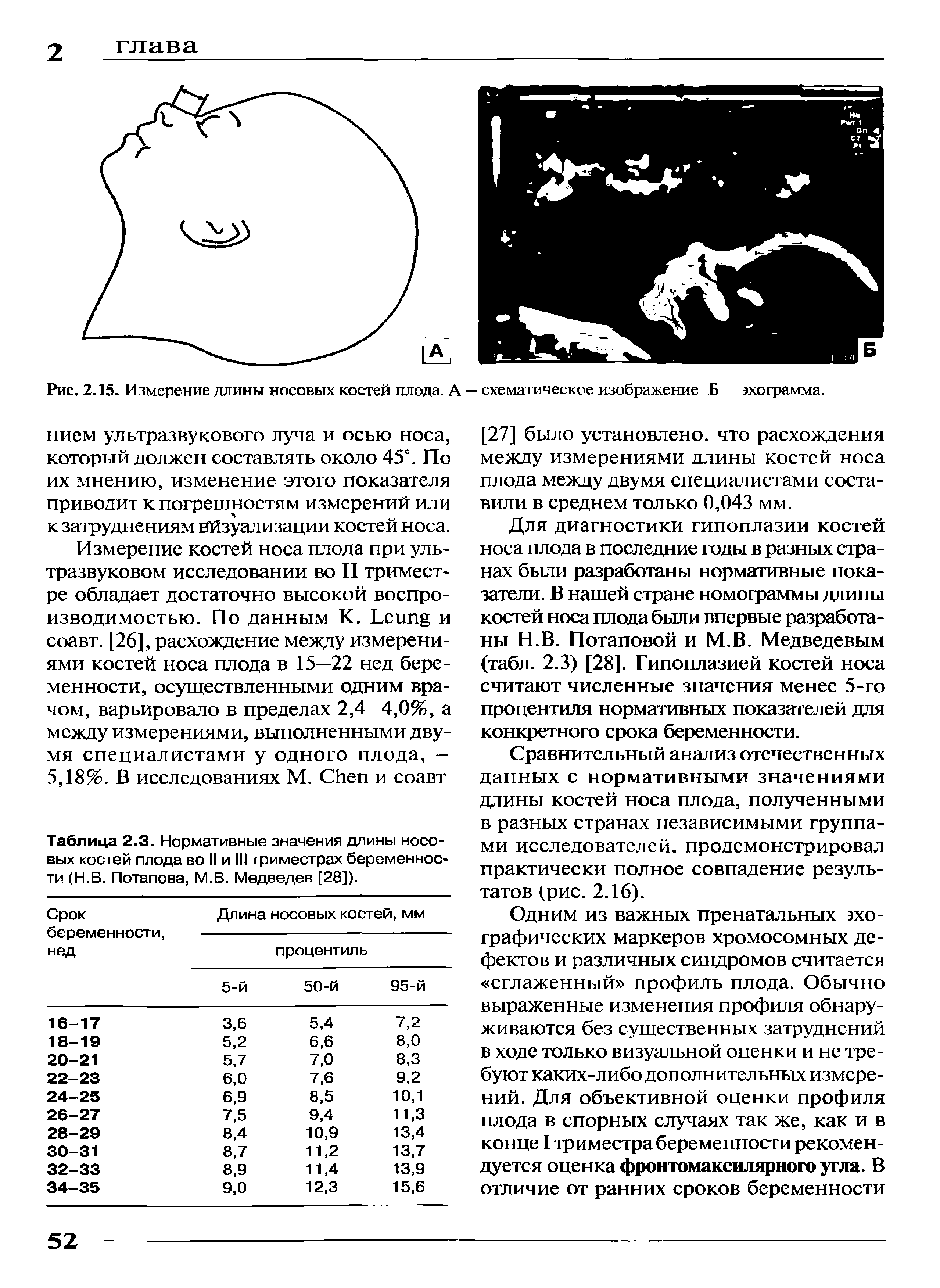 Рис. 2.15. Измерение длины носовых костей плода. А — схематическое изображение Б эхограмма.