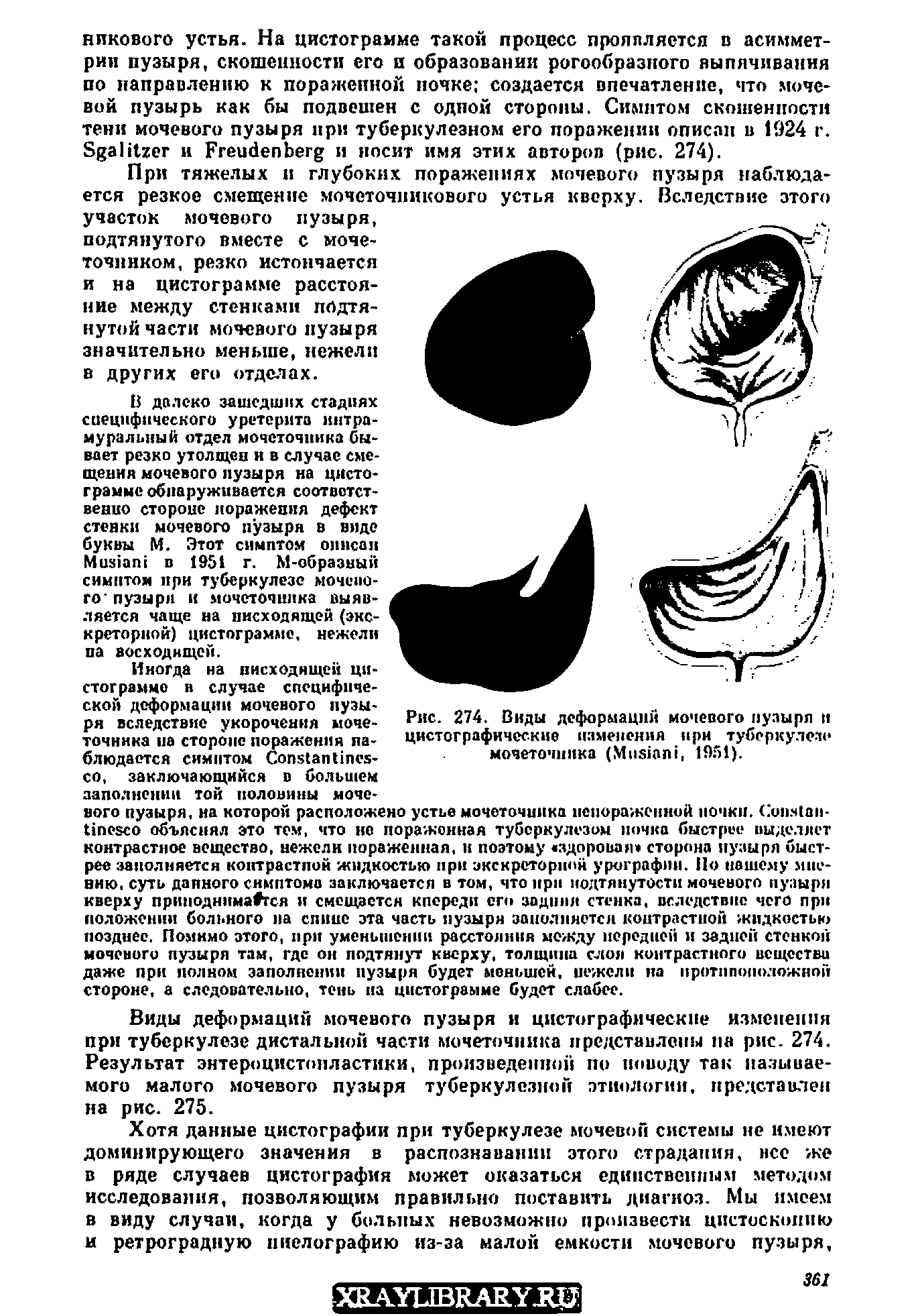Рис. 274. Виды деформаций мочевого пузыря и цнстографнческие изменения при туберкулезе мочеточника (M , 1951).