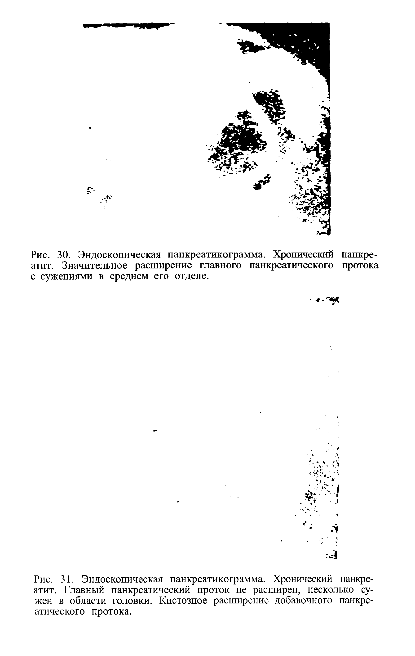 Рис. 31. Эндоскопическая панкреатикограмма. Хронический панкреатит. Главный панкреатический проток не расширен, несколько сужен в области головки. Кистозное расширение добавочного панкреатического протока.