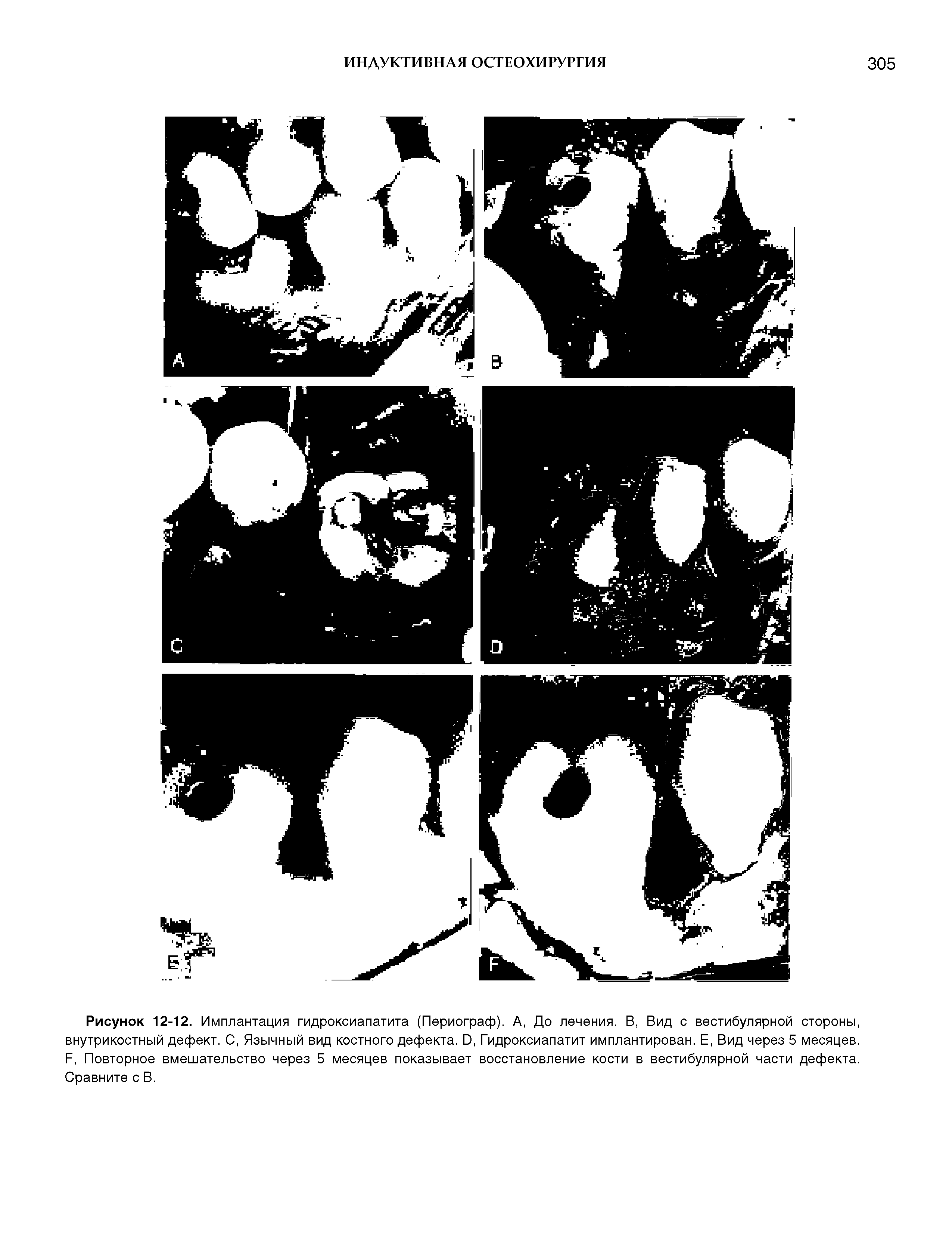 Рисунок 12-12. Имплантация гидроксиапатита (Периограф). А, До лечения. В, Вид с вестибулярной стороны, внутрикостный дефект. С, Язычный вид костного дефекта. О, Гидроксиапатит имплантирован. Е, Вид через 5 месяцев. Е, Повторное вмешательство через 5 месяцев показывает восстановление кости в вестибулярной части дефекта. Сравните с В.