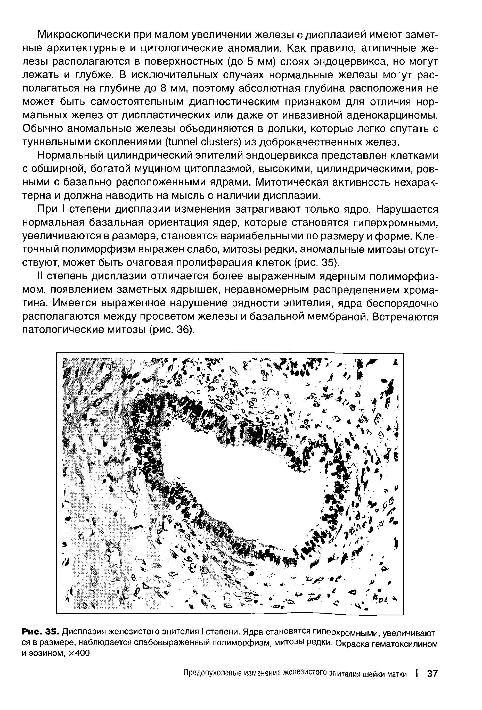 Рис. 33. Дисплазия железистого эпителия I степени. Ядра становятся гиперхромными, увеличивают ся в размере, наблюдается слабовыраженный полиморфизм, митозы редки. Окраска гематоксилином и эозином, х400...