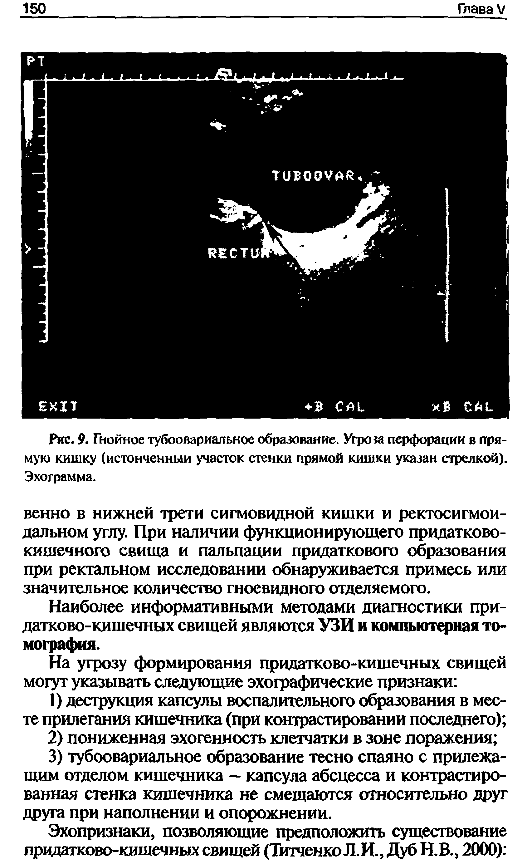 Рис. 9. Гнойное тубоовариальное образование. Угро1а перфорации в прямую кишку (истонченным участок стенки прямой кишки указан стрелкой). Эхограмма.