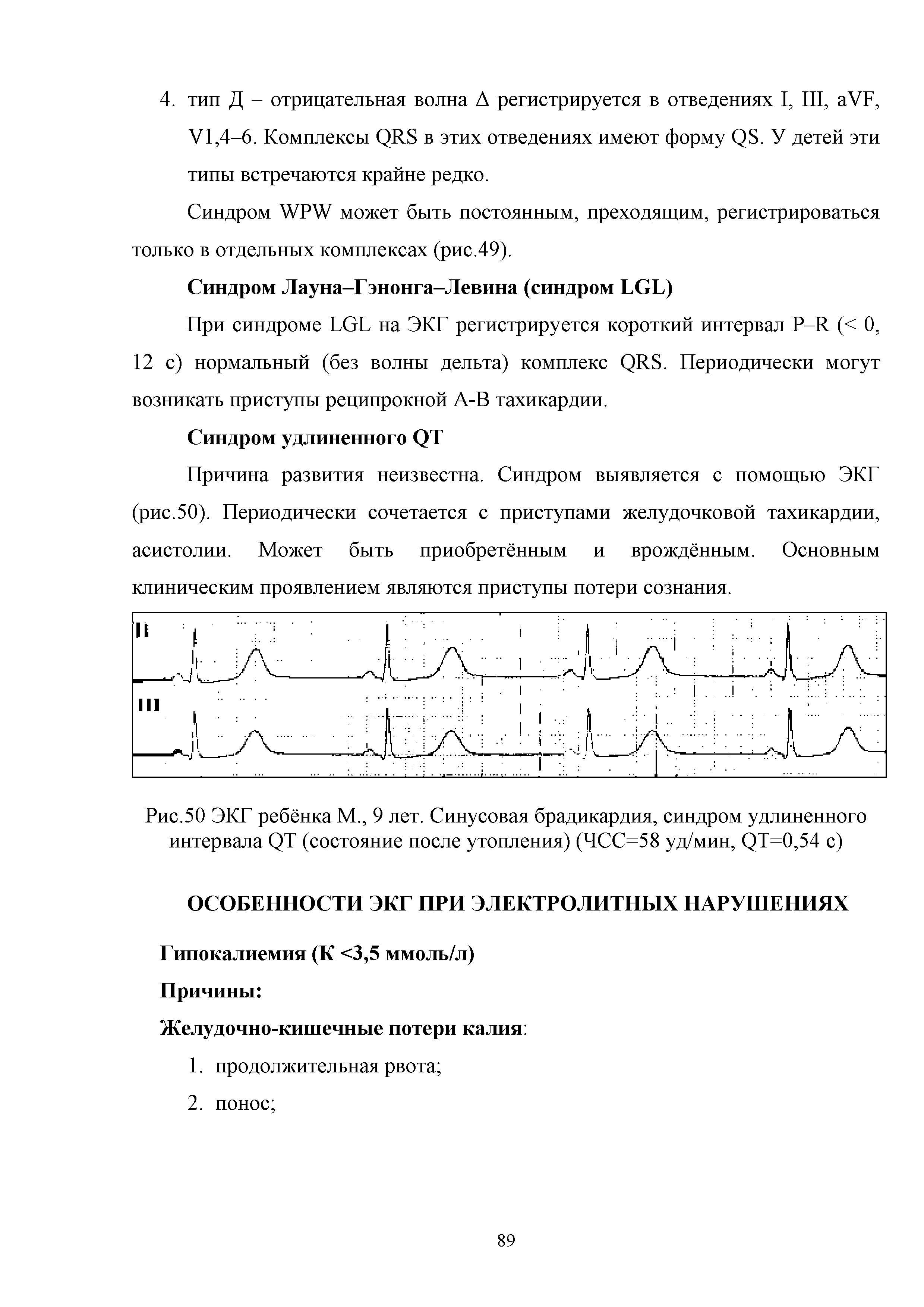 Рис.50 ЭКГ ребёнка М., 9 лет. Синусовая брадикардия, синдром удлиненного интервала ()Т (состояние после утопления) (ЧСС=58 уд/мин, (ДМ), 54 с)...