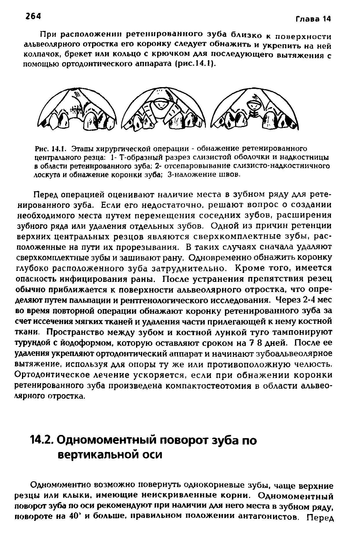 Рис. 14.1. Этапы хирургической операции - обнажение ретенированного центрального резца 1- Т-образный разрез слизистой оболочки и надкостницы в области ретенированного зуба 2- отсепаровывание слизисто-надкостничного лоскута и обнажение коронки зуба 3-наложение швов.