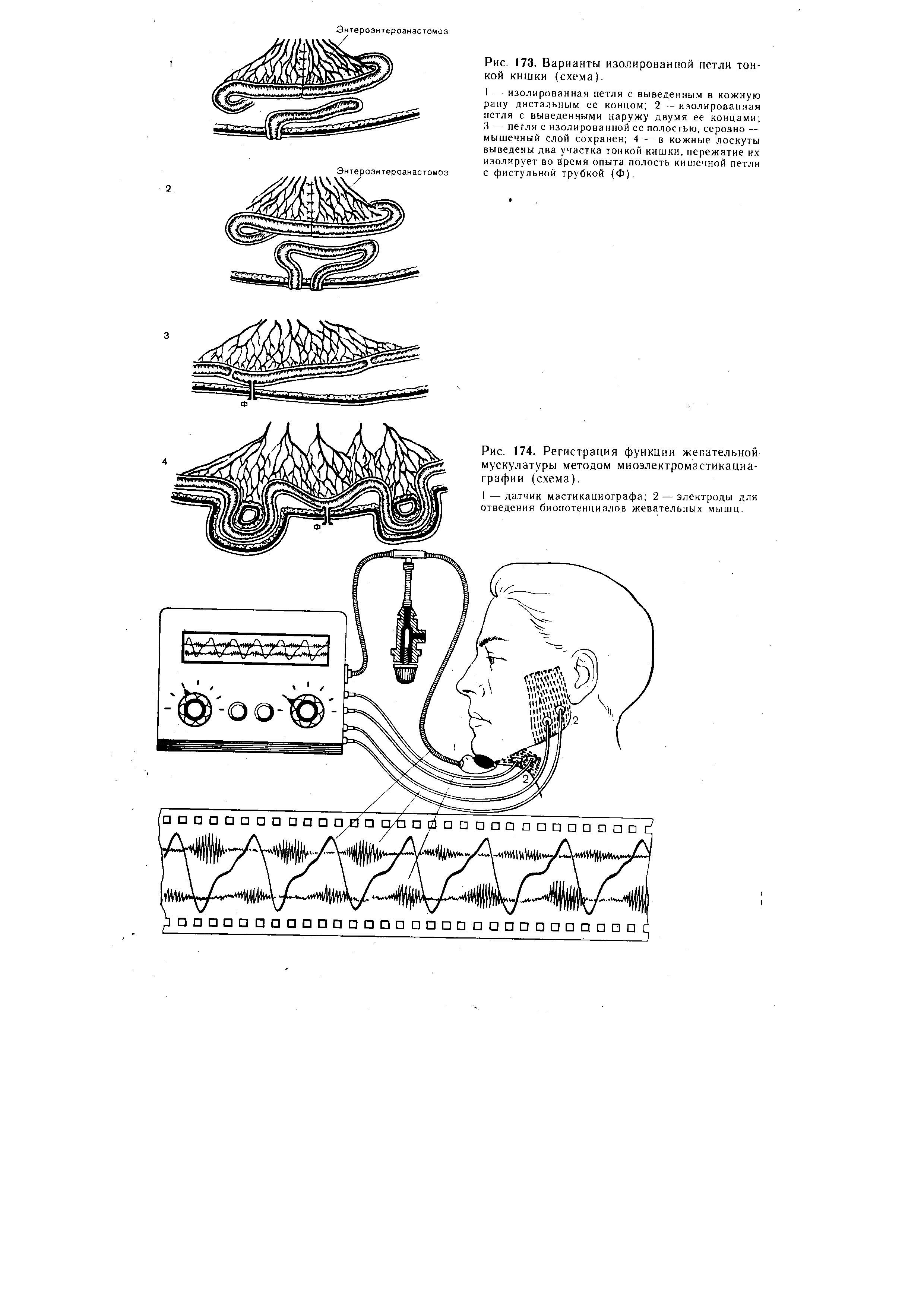 Рис. 174. Регистрация функции жевательной мускулатуры методом миоэлектромастикаииа-графии (схема).