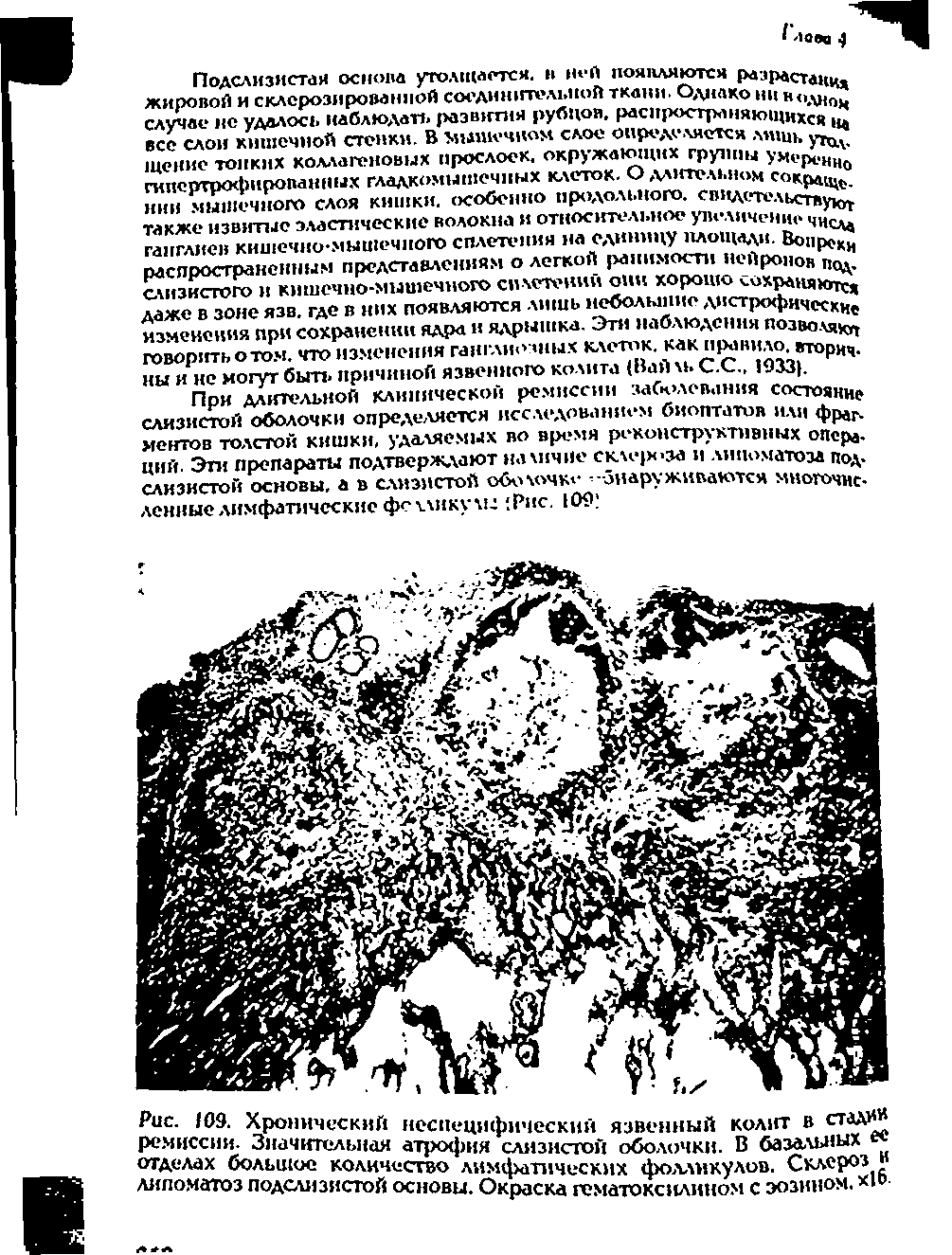 Рис. 109. Хронический неспецифический язвенный колит в стйА1 ремиссии. Значительная атрофия слизистой оболочки. В базальных отделах большое количество лимфатических фолликулов. Склероз липоматоз подслизистой основы. Окраска гематоксилином с эозином, хте-...