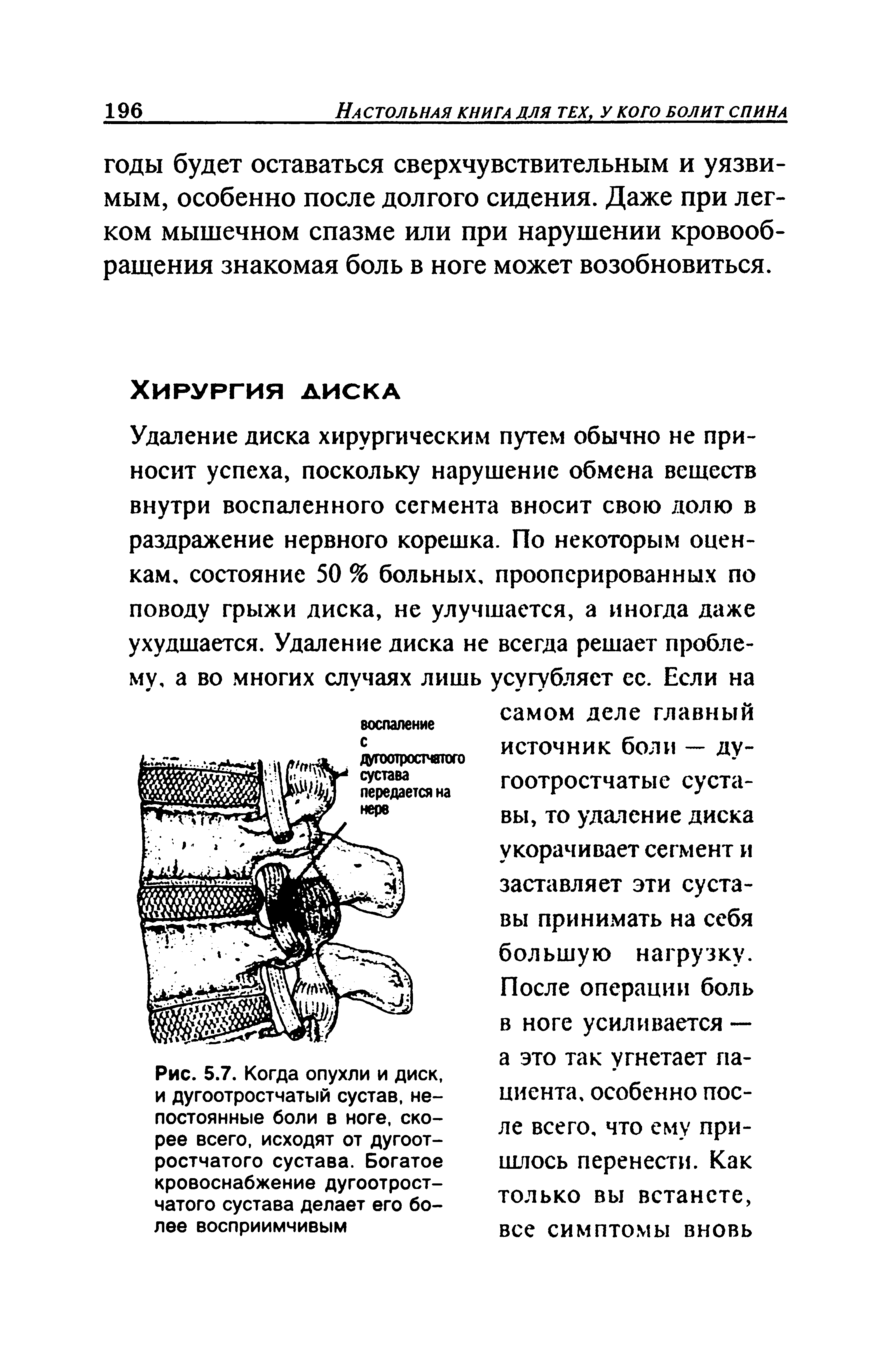 Рис. 5.7. Когда опухли и диск, и дугоотростчатый сустав, непостоянные боли в ноге, скорее всего, исходят от дугоот-ростчатого сустава. Богатое кровоснабжение дугоотрост-чатого сустава делает его более восприимчивым...