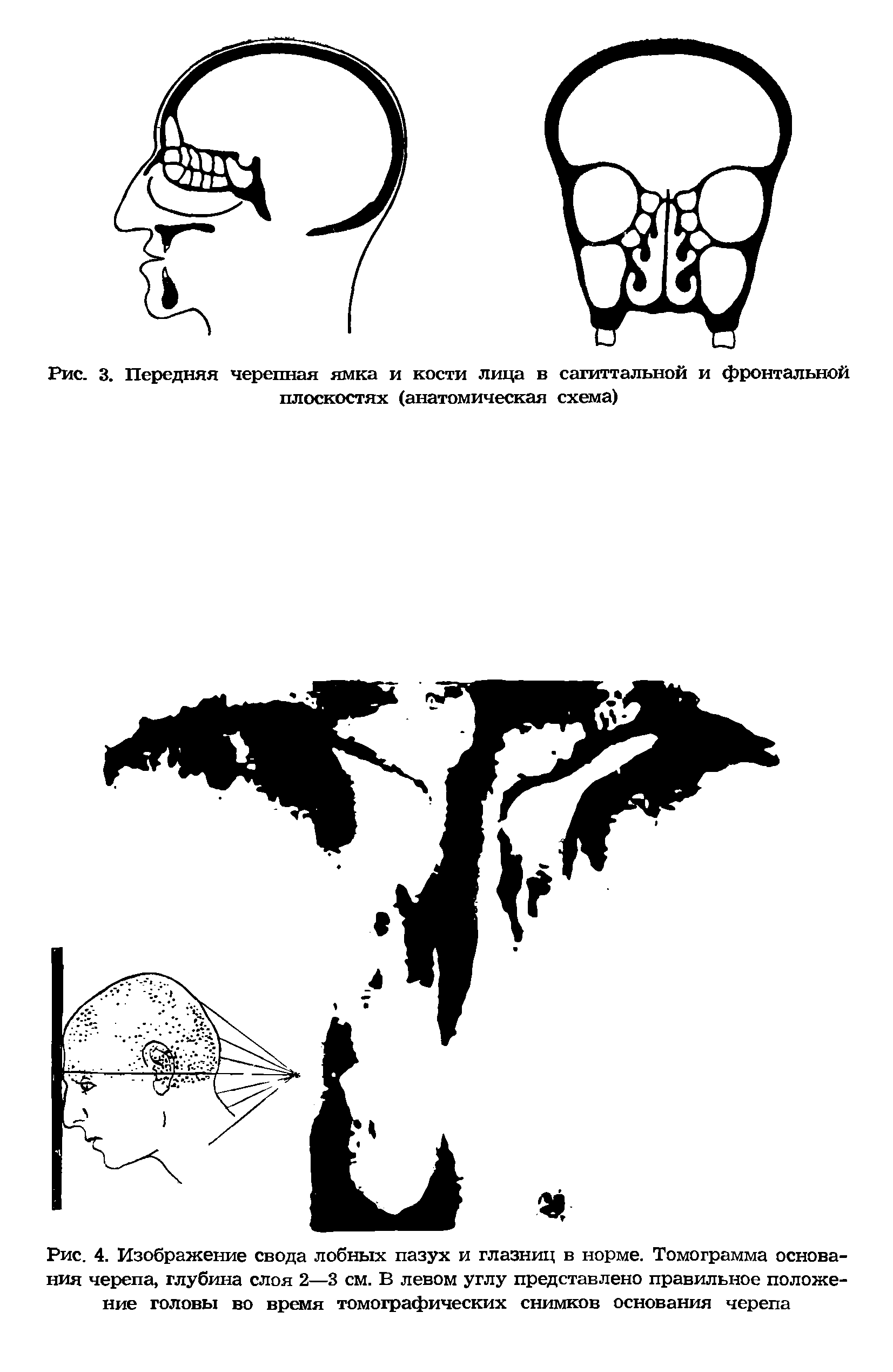 Рис. 4. Изображение свода лобных пазух и глазниц в норме. Томограмма основания черепа, глубина слоя 2—3 см. В левом углу представлено правильное положение головы во время томографических снимков основания черепа...