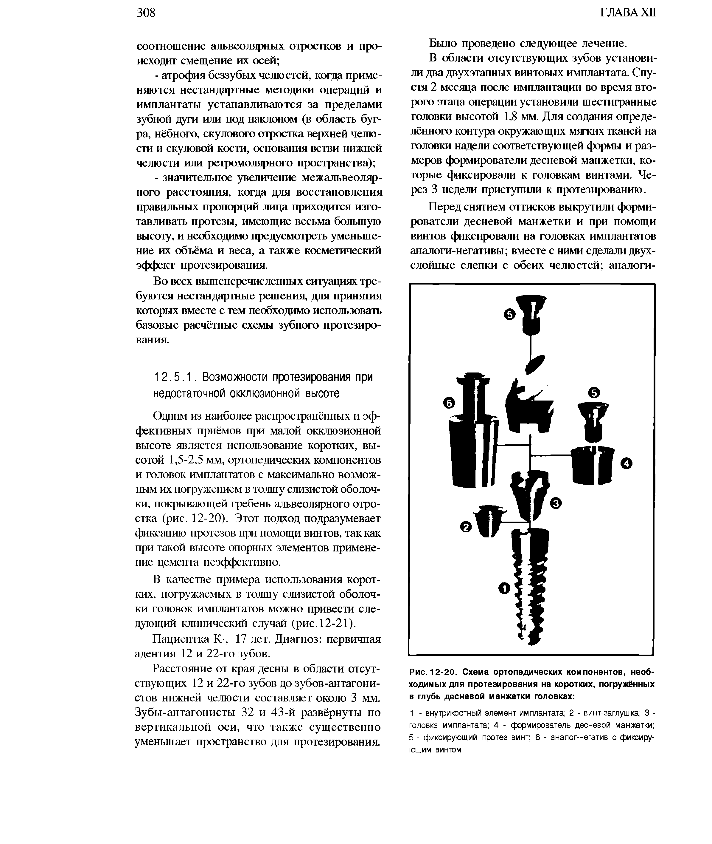 Рис. 12-20. Схема ортопедических компонентов, необходимых для протезирования на коротких, погружённых в глубь десневой манжетки головках ...