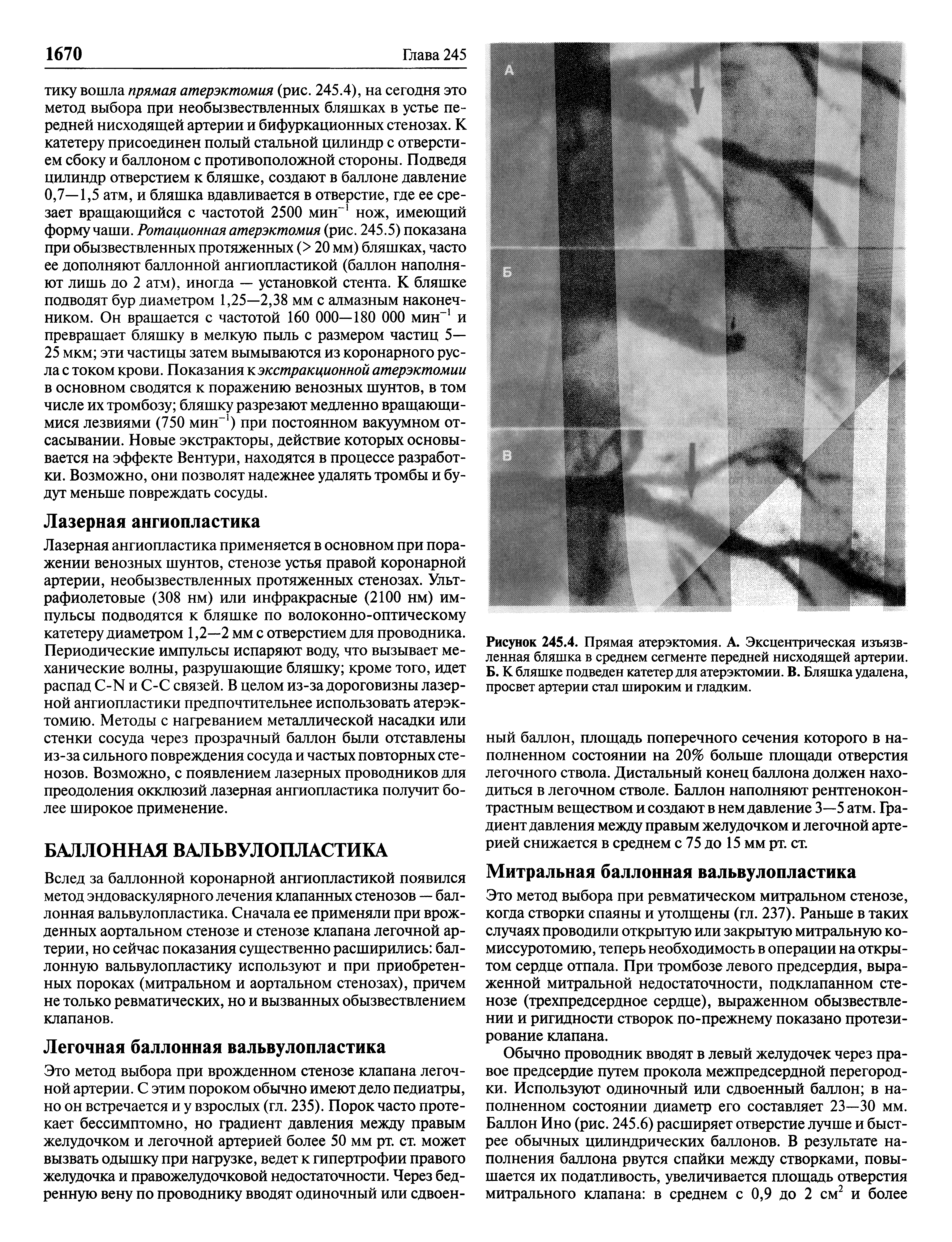 Рисунок 245.4. Прямая атерэктомия. А. Эксцентрическая изъязвленная бляшка в среднем сегменте передней нисходящей артерии. Б. К бляшке подведен катетер для атерэктомии. В. Бляшка удалена, просвет артерии стал широким и гладким.