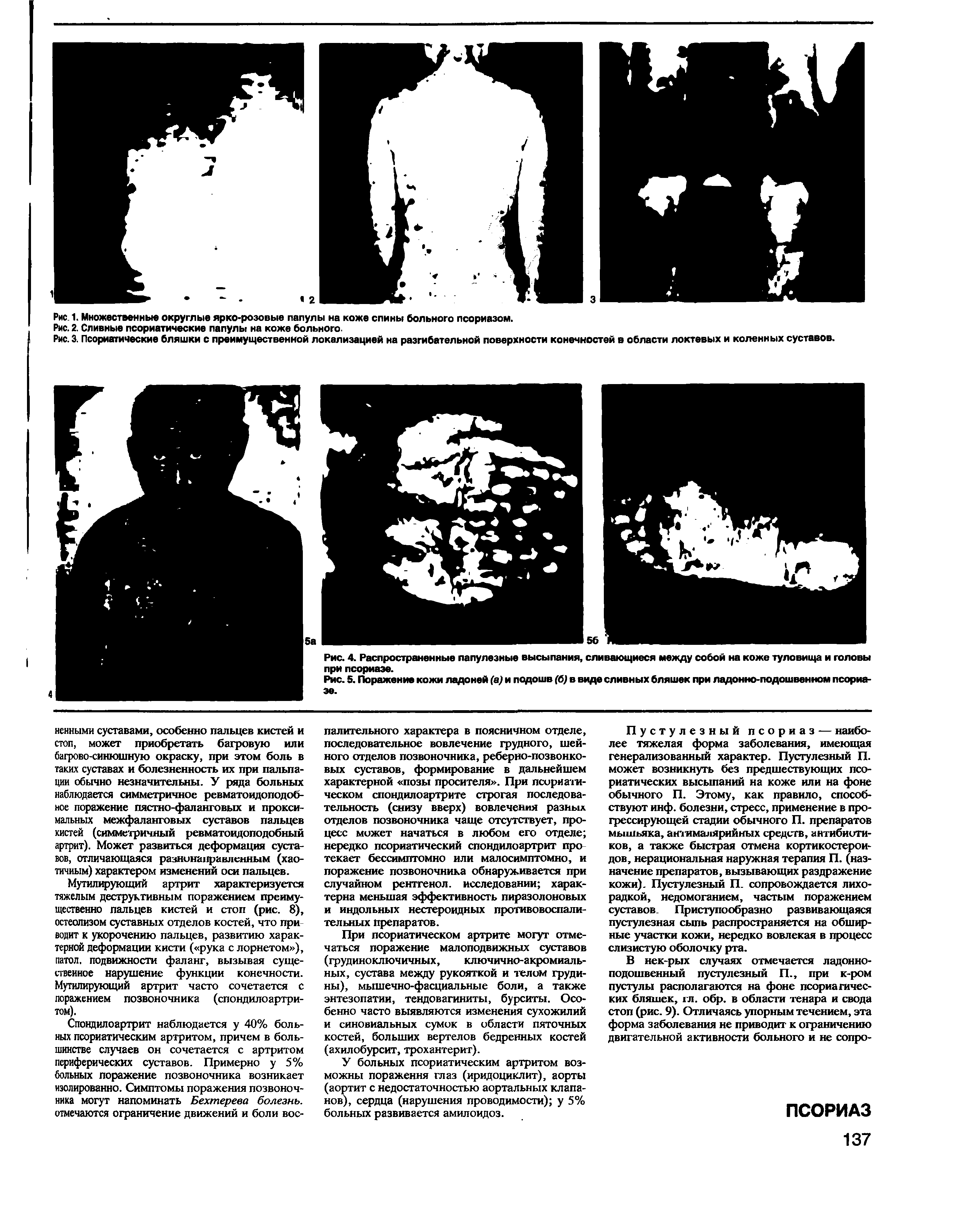 Рис. 3. Псориатические бляшки с преимущественной локализацией на разгибательной поверхности конечностей в области локтевых и коленных суставов.