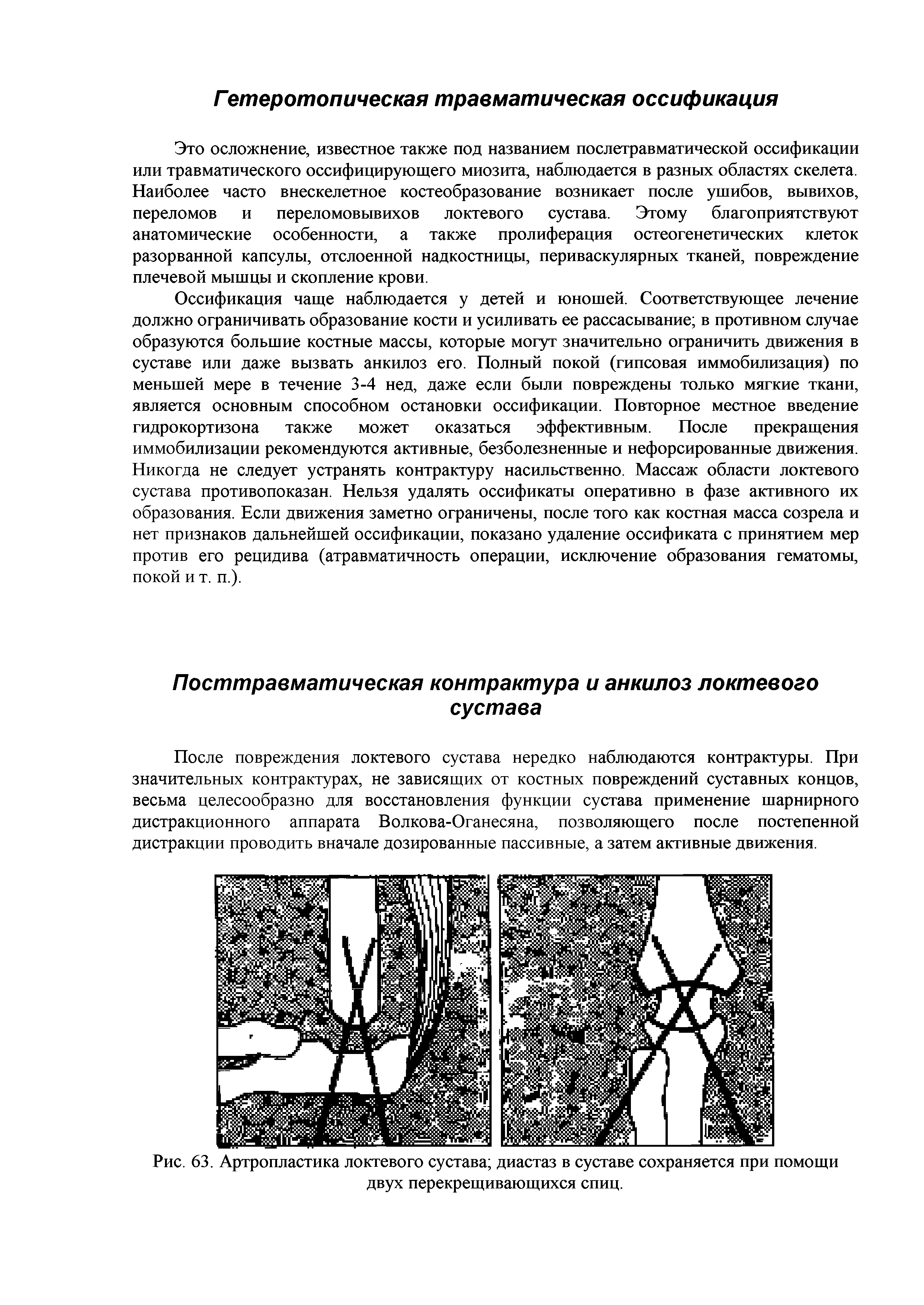 Рис. 63. Артропластика локтевого сустава диастаз в суставе сохраняется при помощи...