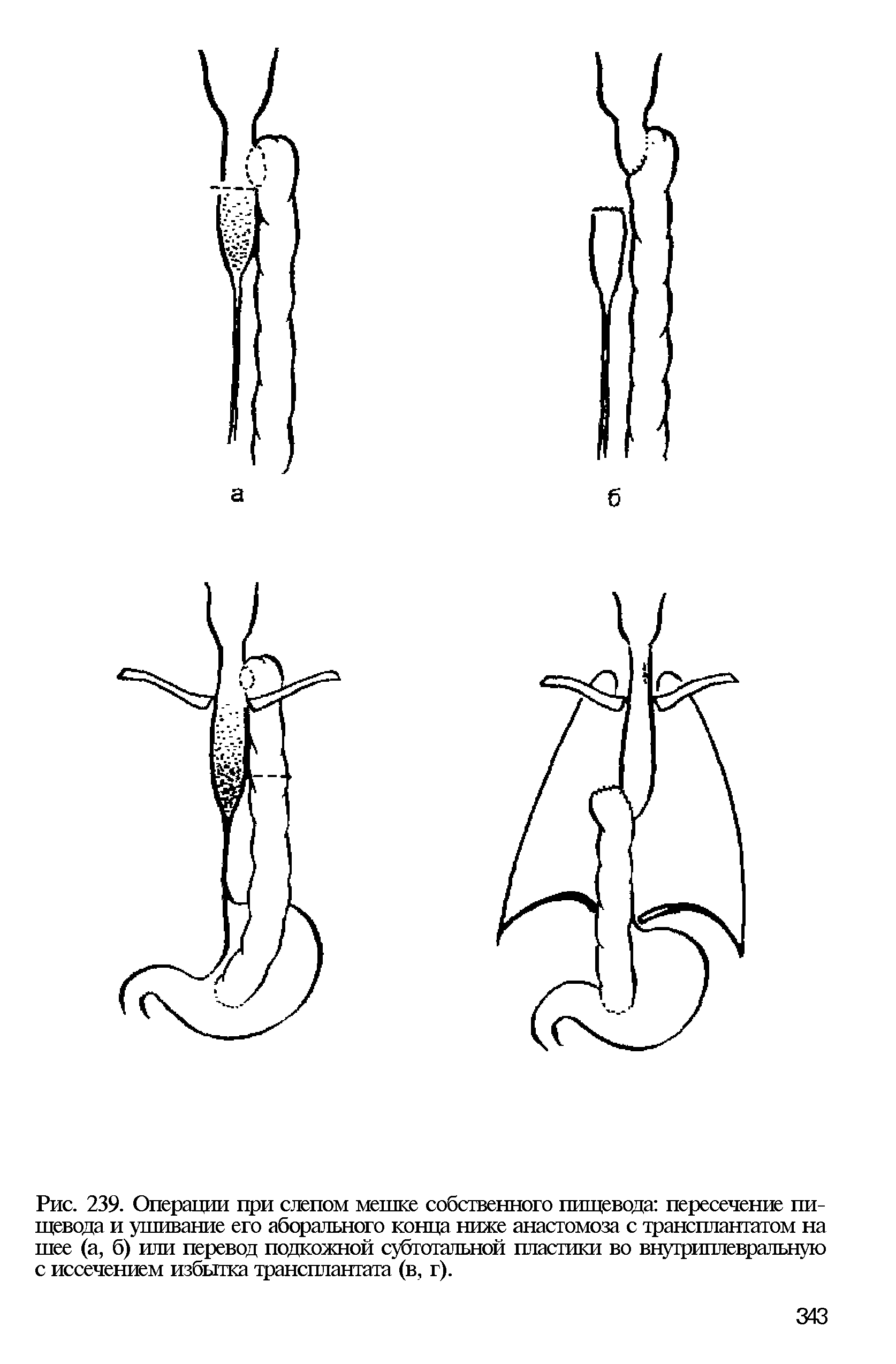 Рис. 239. Операции при слепом мешке собственного пищевода пересечение пищевода и ушивание его аборального конца ниже анастомоза с трансплантатом на шее (а, б) или перевод подкожной субпиальной пластики во внутриплевральную с иссечением избытка трансплантата (в, г).