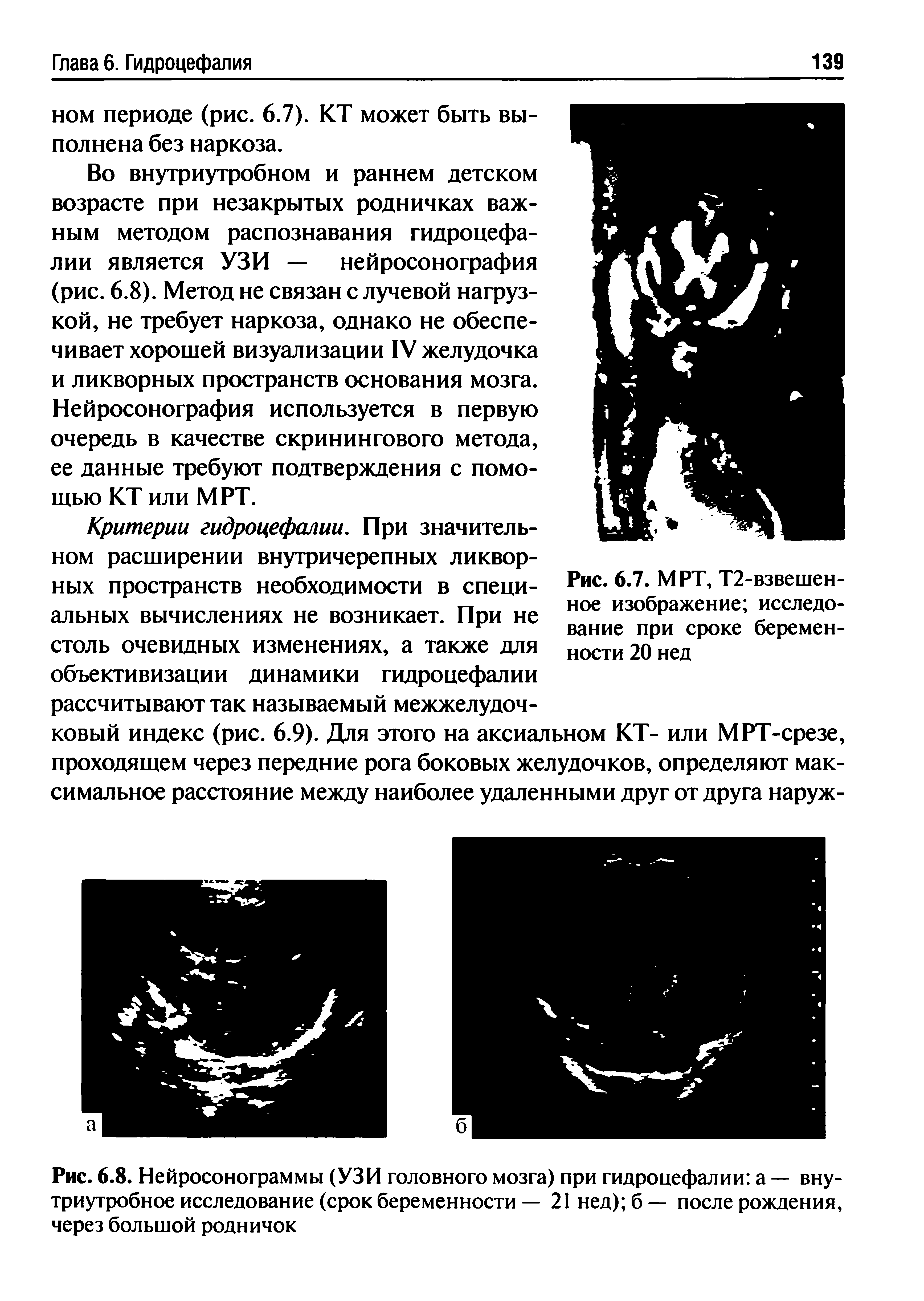 Рис. 6.8. Нейросонограммы (УЗИ головного мозга) при гидроцефалии а — внутриутробное исследование (срок беременности — 21 нед) б— после рождения, через большой родничок...