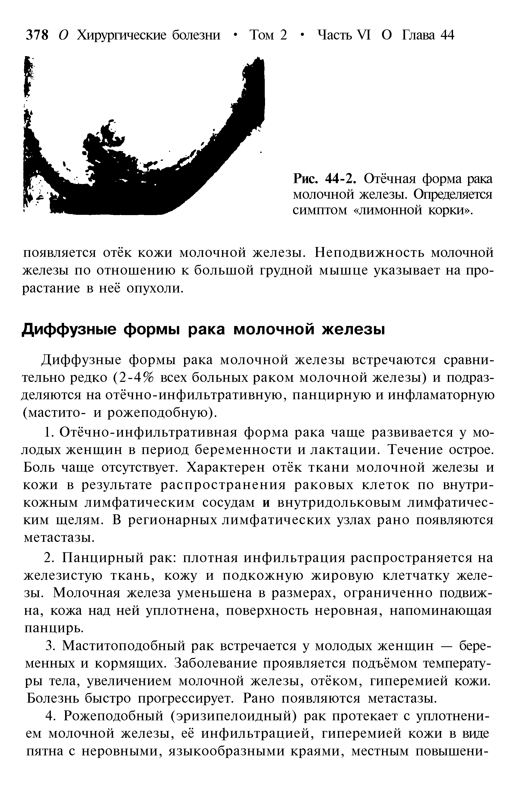 Рис. 44-2. Отёчная форма рака молочной железы. Определяется симптом лимонной корки .