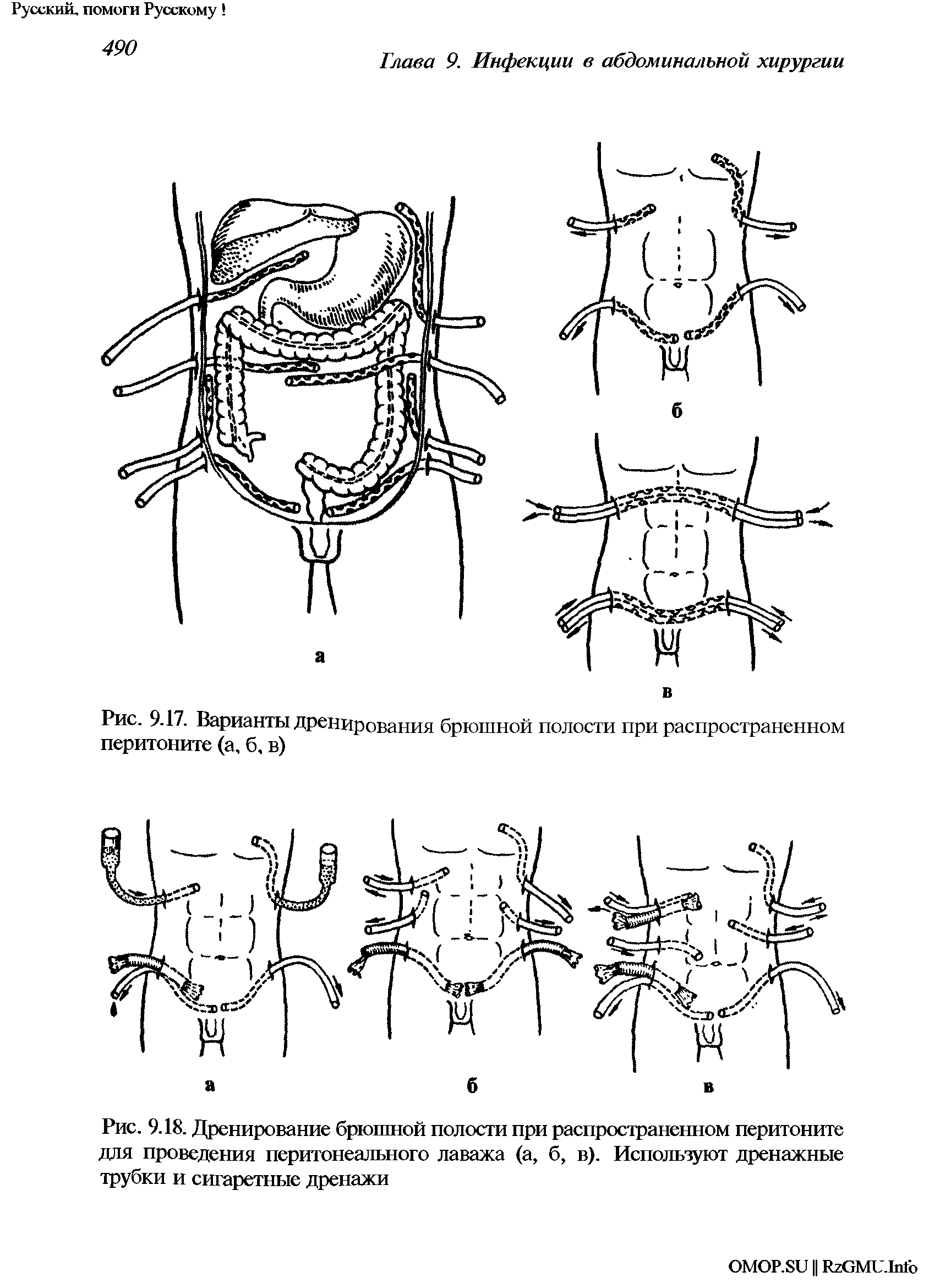 Рис. 9.18. Дренирование брюшной полости при распространенном перитоните для проведения перитонеального лаважа (а, б, в). Используют дренажные трубки и сигаретные дренажи...