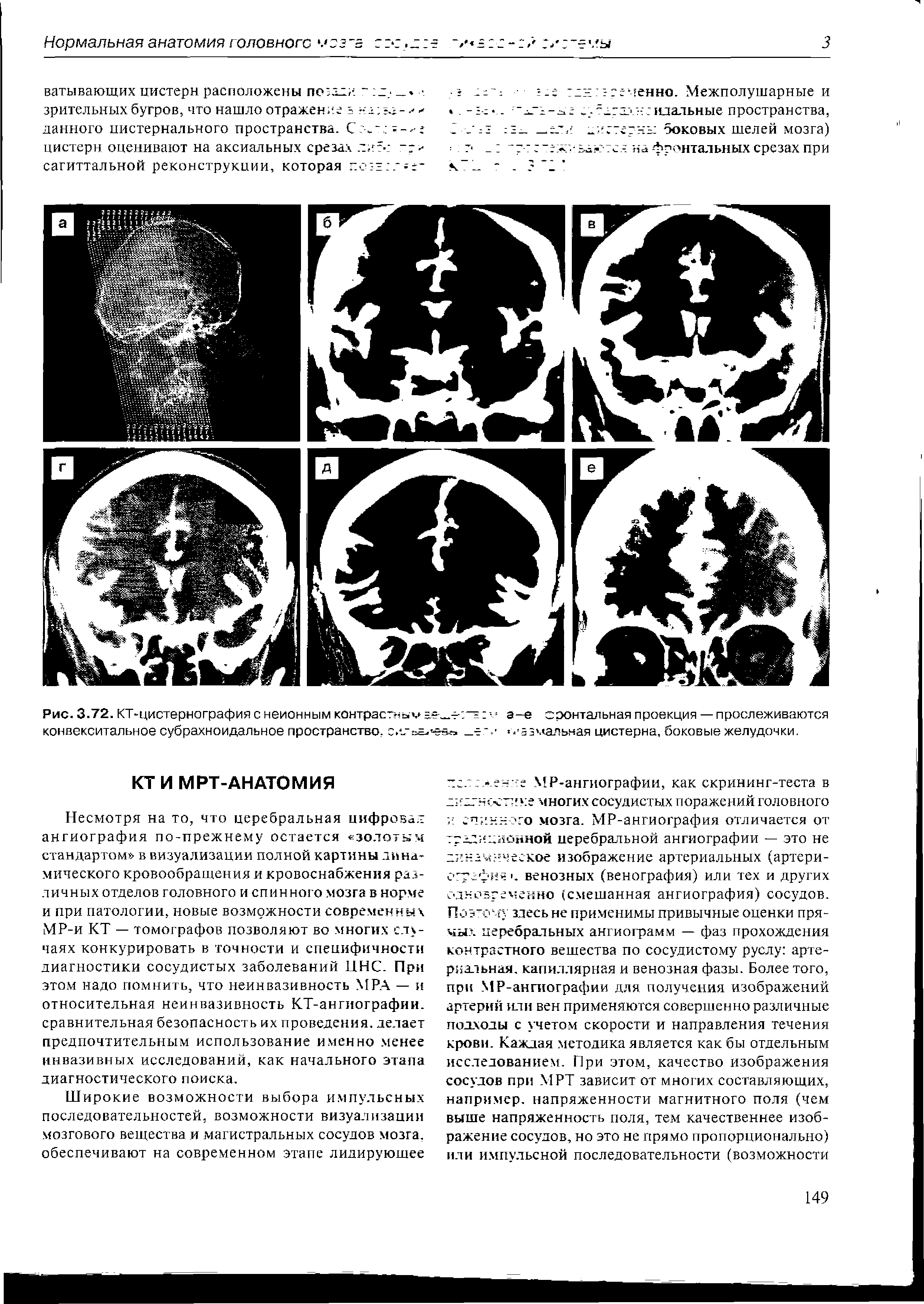 Рис. 3.72. КТ-цистернография с неионным контрастны. = V а-е фронтальная проекция — прослеживаются конвекситальное субрахноидальное пространство, с.с.-а. ев . ззмальная цистерна, боковые желудочки.