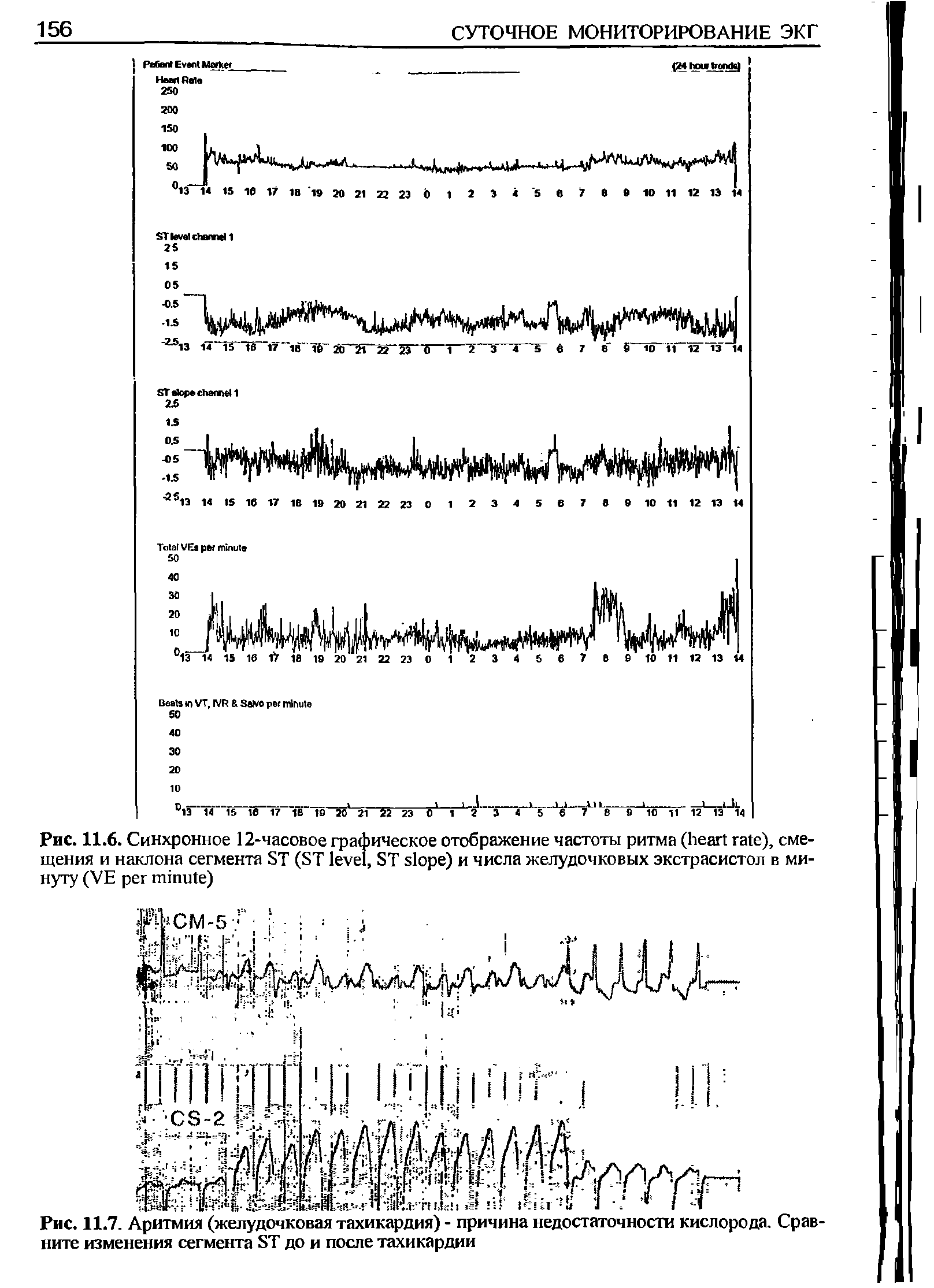 Рис. 11.7. Аритмия (желудочковая тахикардия) - причина недостаточности кислорода. Сравните изменения сегмента 8Т до и после тахикардии...