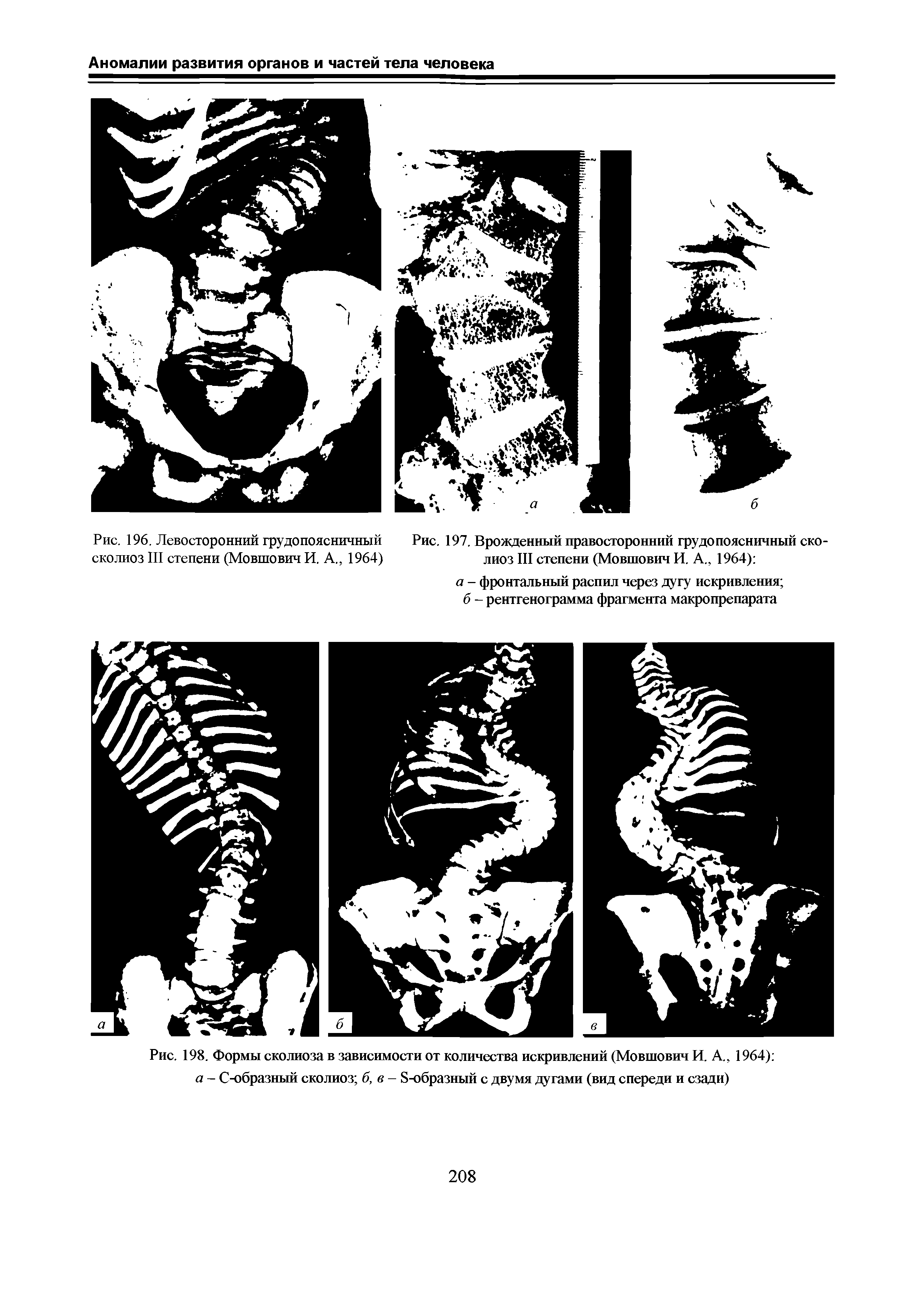 Рис. 197. Врожденный правосторонний грудопоясничный сколиоз III степени (Мовшович И. А., 1964) ...