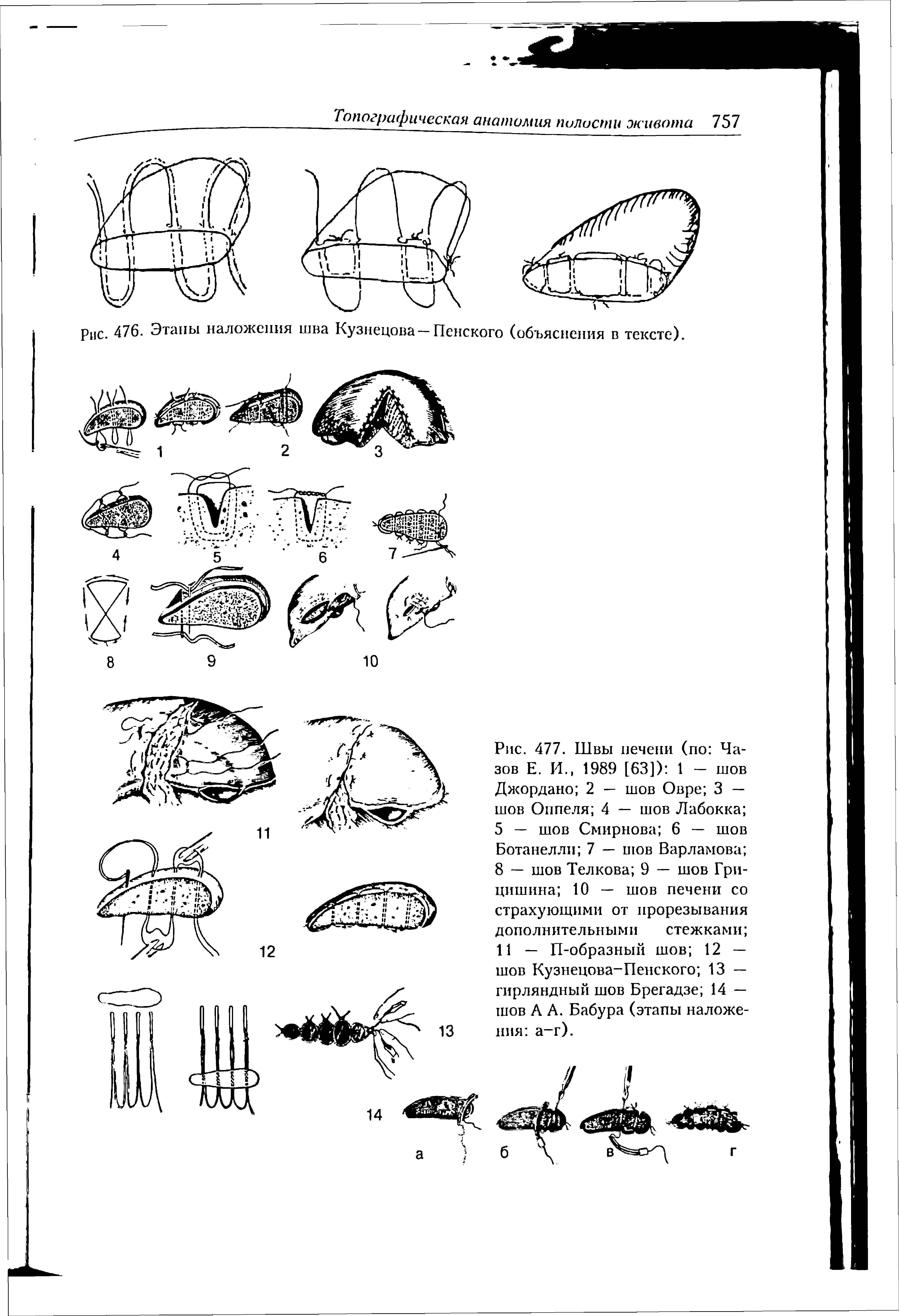 Рис. 477. Швы печени (по Чазов Е. И., 1989 [63]) 1 — шов Джордано 2 — шов Овре 3 — шов Оппеля 4 — шов Лабокка 5 — шов Смирнова 6 — шов Ботанелли 7 — шов Варламова 8 — шов Телкова 9 — шов Гри-цишина 10 — шов печени со страхующими от прорезывания дополнительными стежками 11 — П-образный шов 12 — шов Кузнецова-Пенского 13 — гирляндный шов Брегадзе 14 — шов А А. Бабура (этапы наложения а-г).