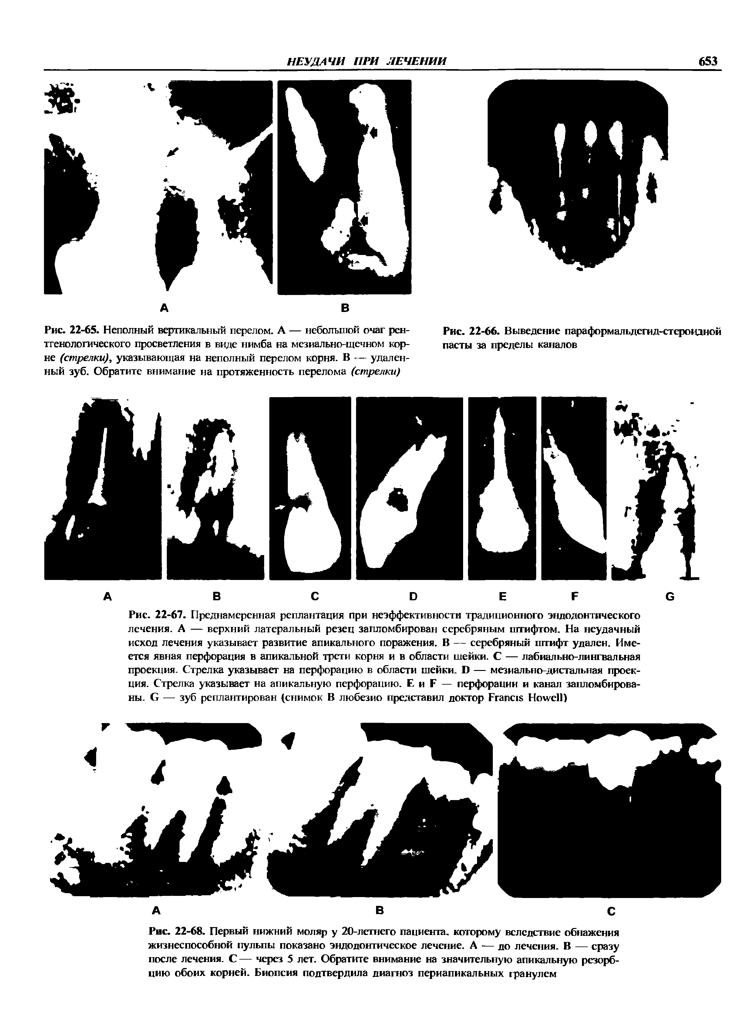 Рис. 22-65. Неполный вертикальный перелом. А — небольшой очаг рентгенологического просветления в виде нимба на мезиально-щечном корне (стрелки), указывающая на неполный перелом корня. В — удаленный зуб. Обратите внимание на протяженность перелома (стрелки)...