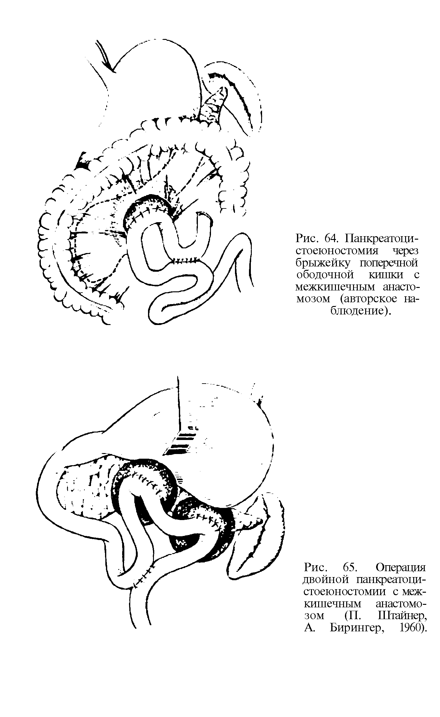 Рис. 65. Операция двойной панкреатоци-стоеюностомии с межкишечным анастомозом (П. Штайнер, А. Бирингер, 1960).