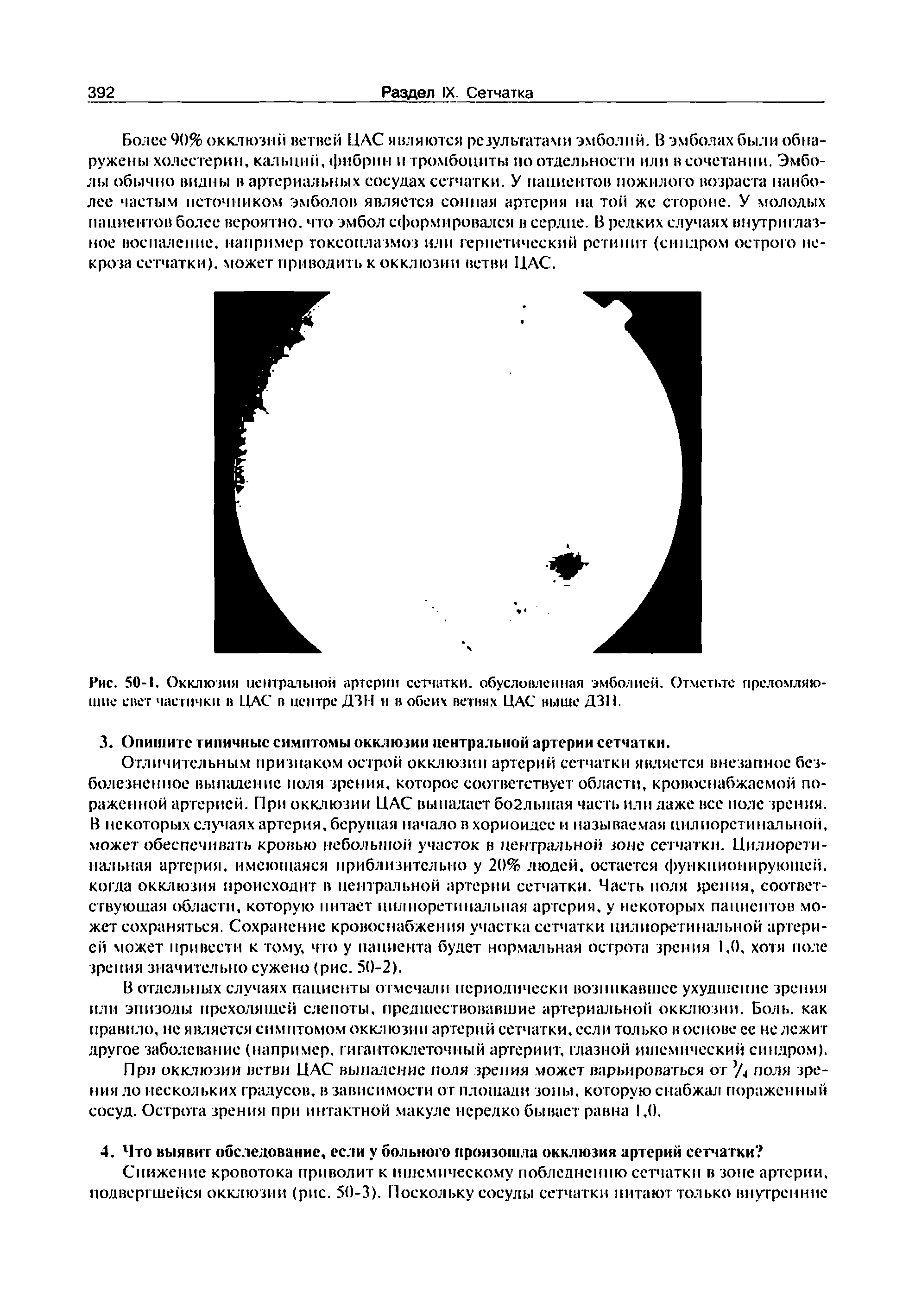 Рис. 50-1. Окклюзия центральной артерии сетчатки, обусловленная эмболией. Отметьте преломляющие свет частички в ЦАС в центре ДЗН и в обеих ветвях ЦАС выше ДЗП.