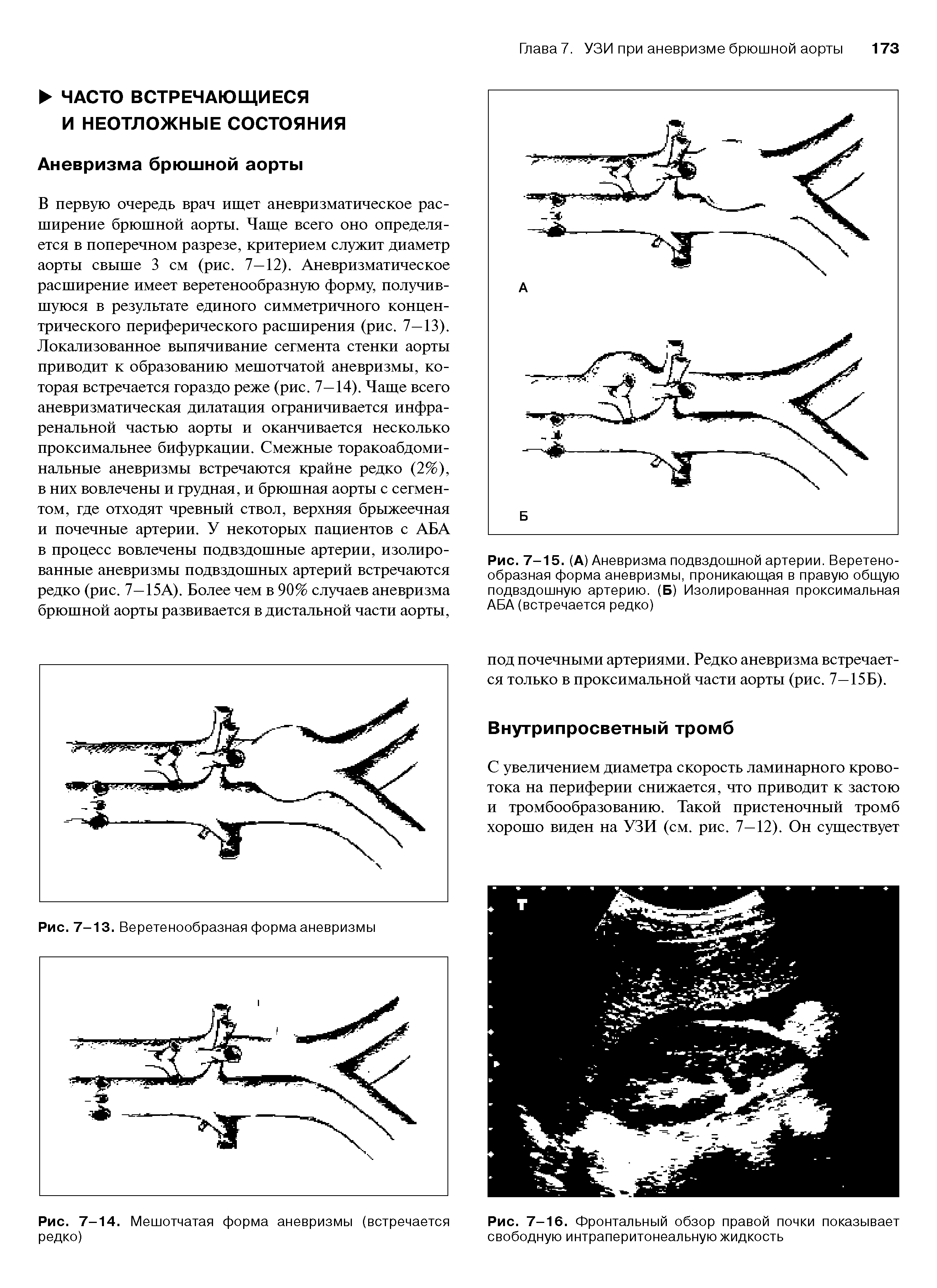 Рис. 7-15. (А) Аневризма подвздошной артерии. Веретенообразная форма аневризмы, проникающая в правую общую подвздошную артерию. (Б) Изолированная проксимальная АБА (встречается редко)...