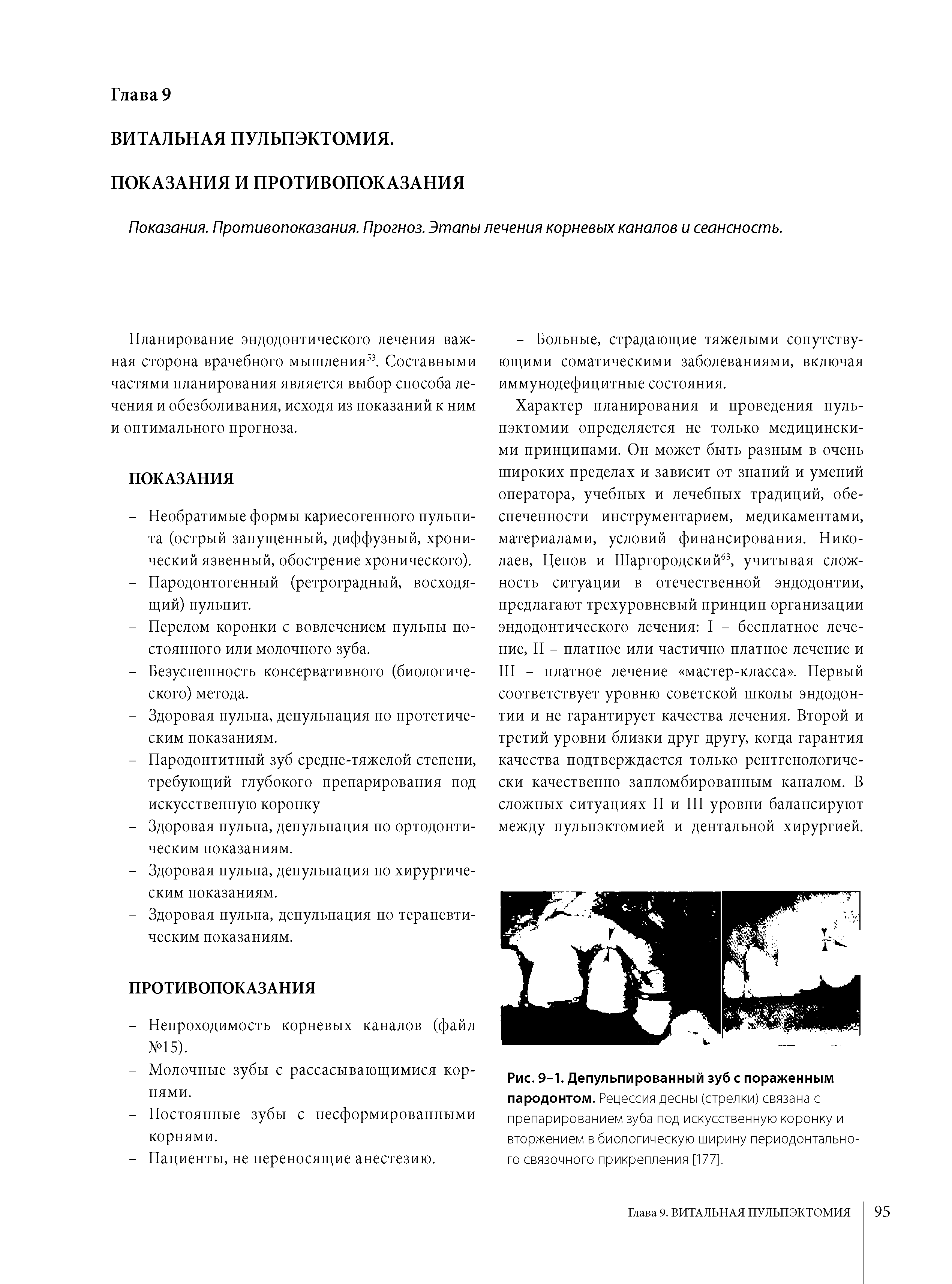 Рис. 9-1. Депульпированный зуб с пораженным пародонтом. Рецессия десны (стрелки) связана с препарированием зуба под искусственную коронку и вторжением в биологическую ширину периодонтального связочного прикрепления [177].