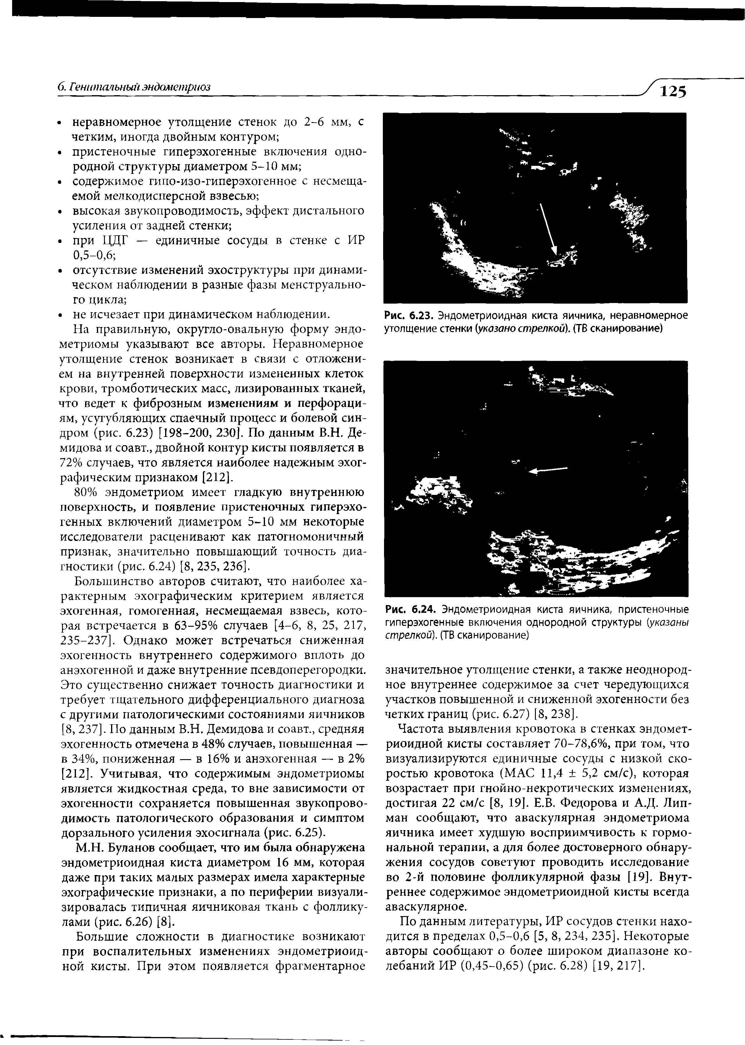 Рис. 6.23. Эндометриоидная киста яичника, неравномерное утолщение стенки (указано стрелкой). (ТВ сканирование)...