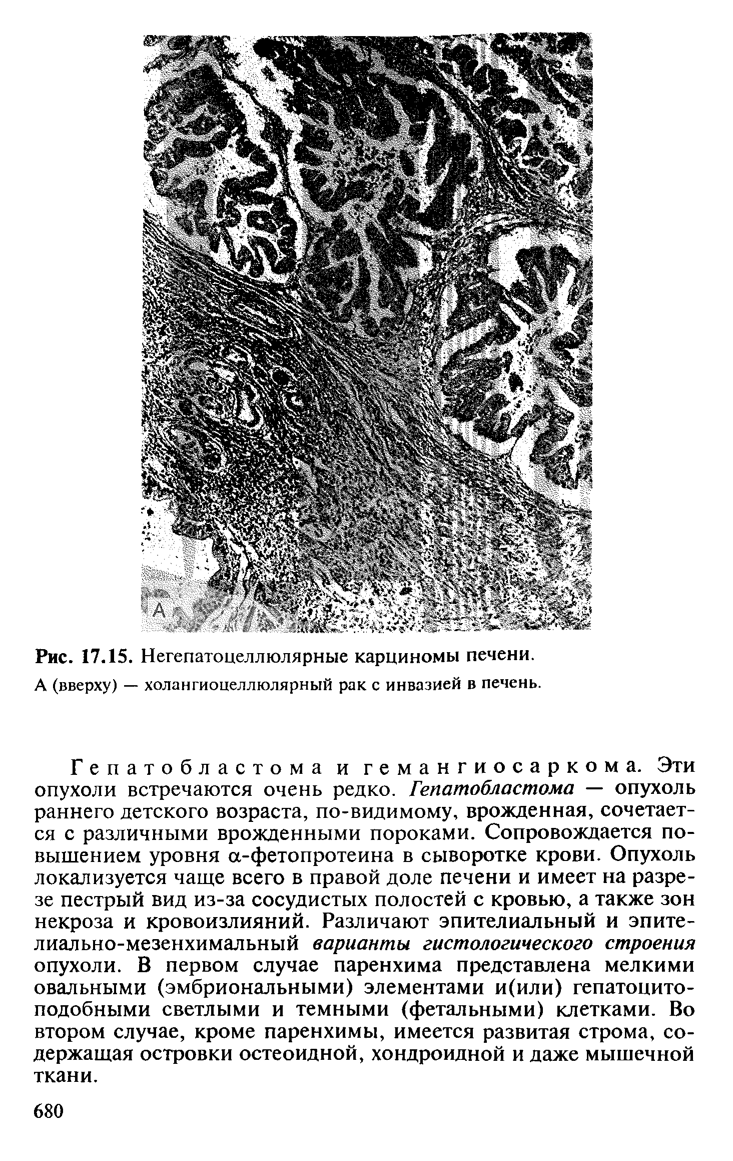 Рис. 17.15. Негепатоцеллюлярные карциномы печени. А (вверху) — холангиоцеллюлярный рак с инвазией в печень.