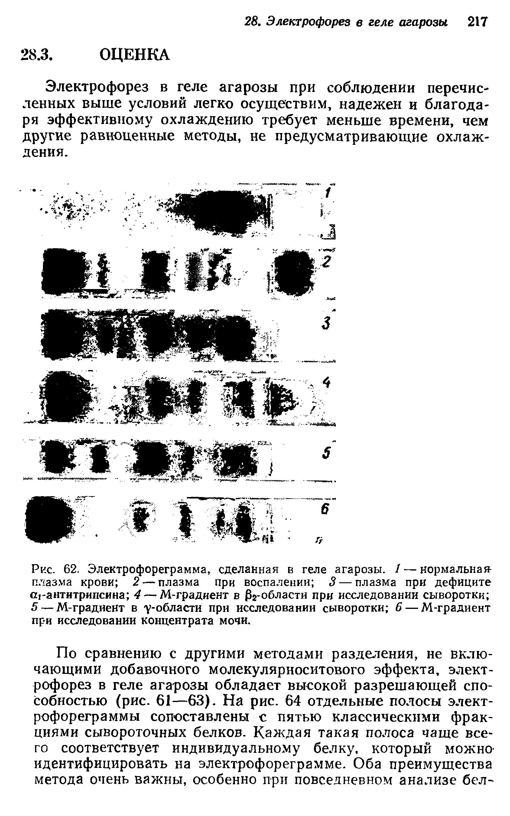 Рис. 62. Электрофореграмма, сделанная в геле агарозы. 1 — нормальная плазма крови 2 — плазма при воспалении 3 — плазма при дефиците агантитрипсина 4 — М-градиент в Зг-области при исследовании сыворотки 5 — М-градиент в у-области при исследовании сыворотки 6 — М-градиент при исследовании концентрата мочи.