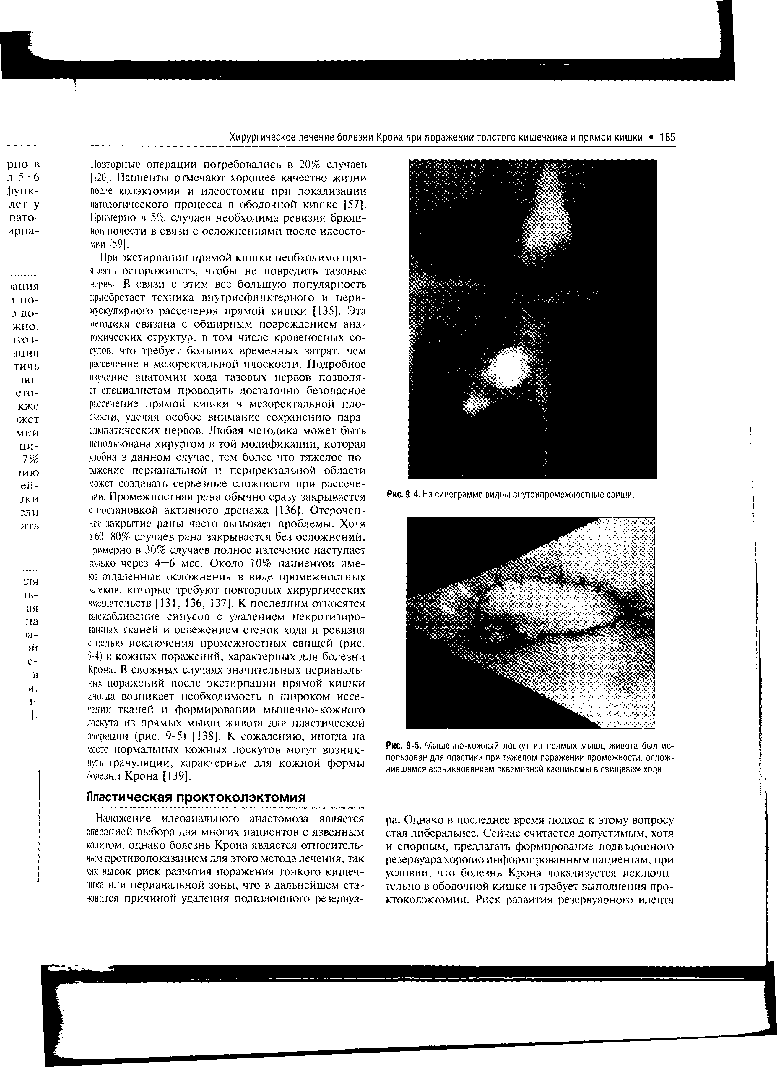 Рис. 9-5. Мышечно-кожный лоскут из прямых мышц живота был использован для пластики при тяжелом поражении промежности, осложнившемся возникновением сквамозной карциномы в свищевом ходе.