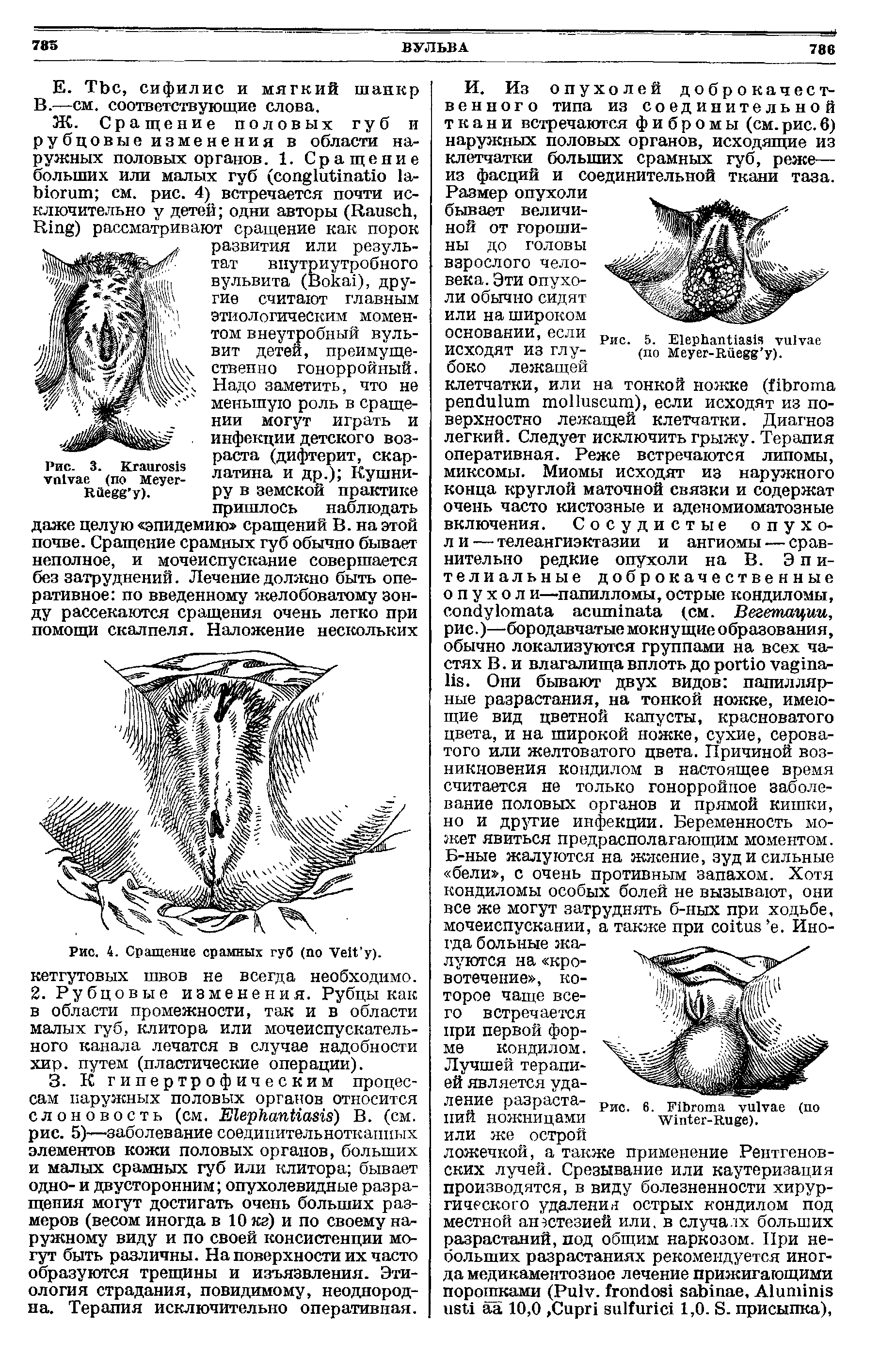 Рис. 4. Сращение срамных губ ( V ). кетгутовых швов не всегда необходимо. 2. Рубцовые изменения. Рубцы как в области промежности, так и в области малых губ, клитора или мочеиспускательного канала лечатся в случае надобности хир. путем (пластические операции).