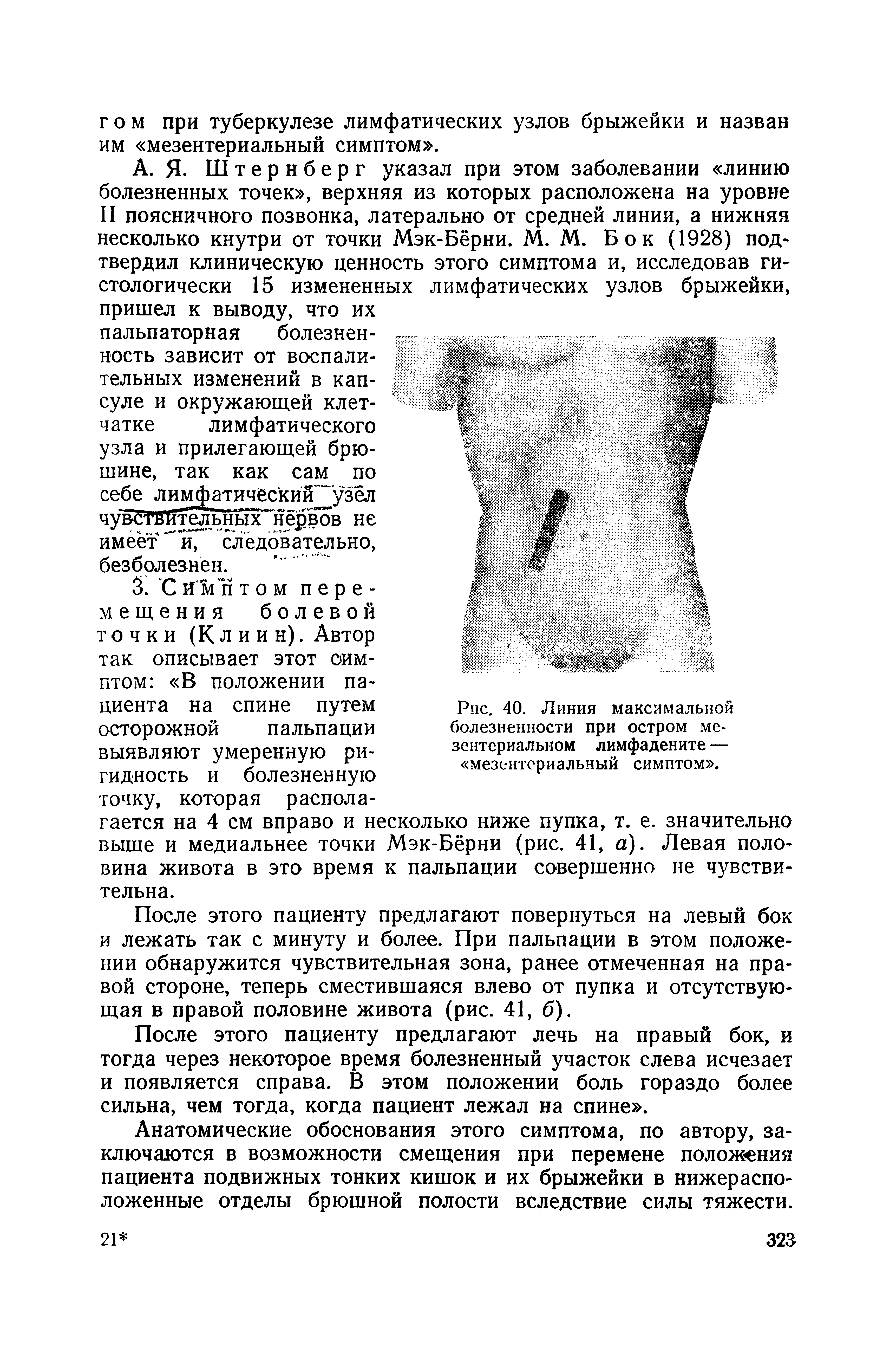 Рис. 40. Линия максимальной болезненности при остром мезентериальном лимфадените — мезентериальный симптом .