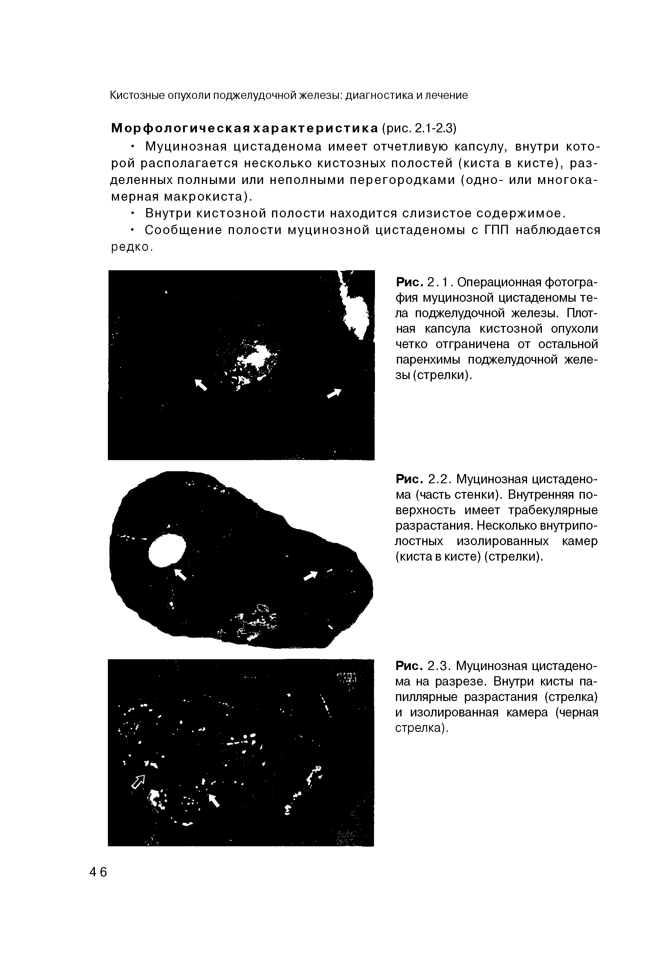 Рис. 2.1. Операционная фотография муцинозной цистаденомы тела поджелудочной железы. Плотная капсула кистозной опухоли четко отграничена от остальной паренхимы поджелудочной железы (стрелки).