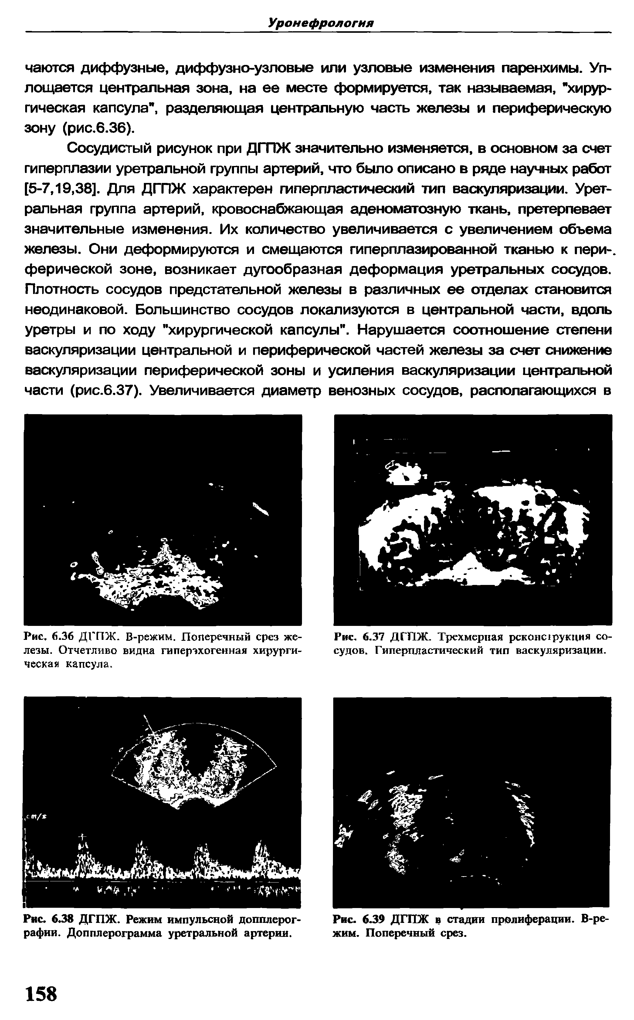 Рис. 6.38 ДГПЖ. Режим импульсной допплерографии. Допплерограмма уретральной артерии.