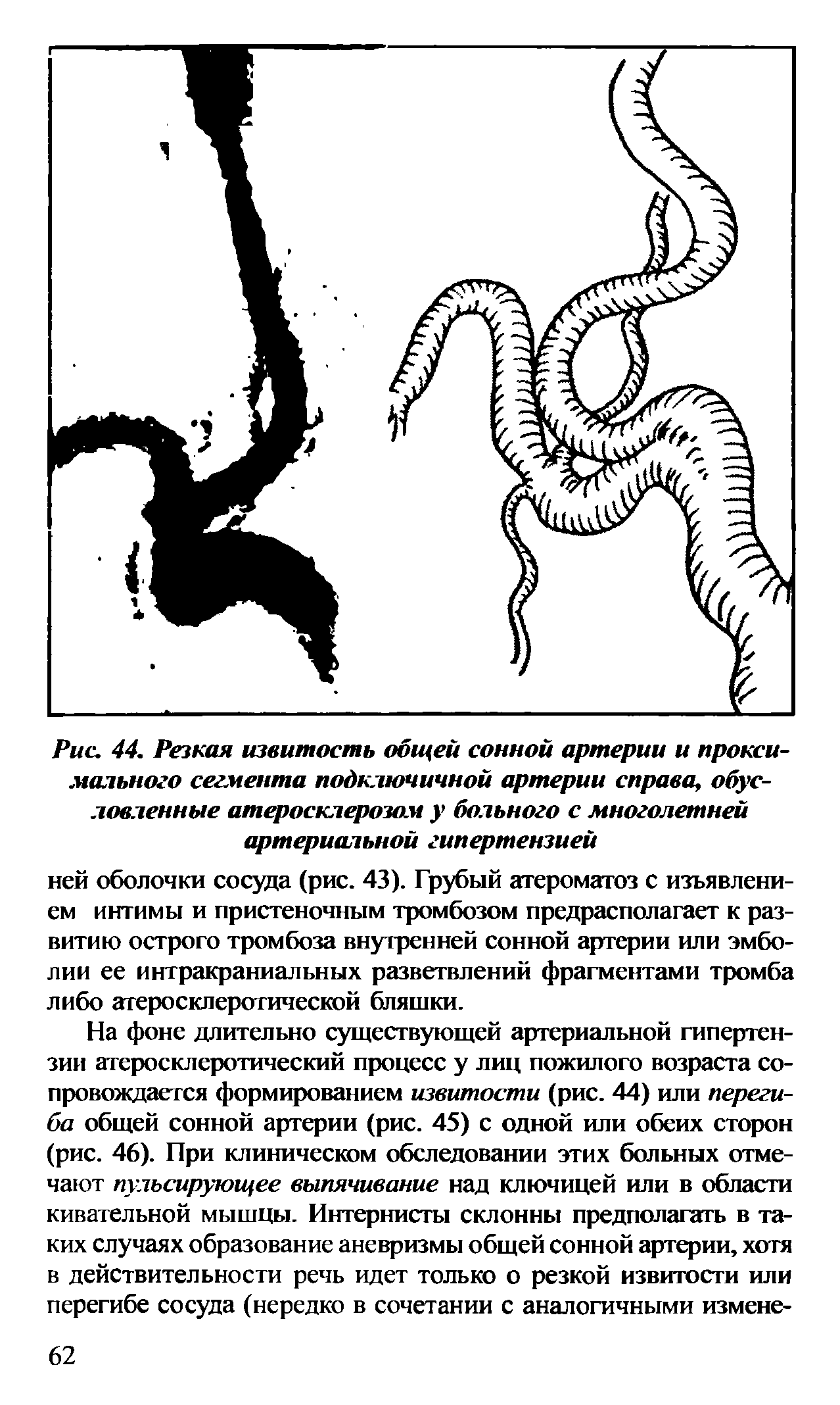 Рис. 44. Резкая извитость общей сонной артерии и проксимального сегмента подключичной артерии справа, обусловленные атеросклерозом у больного с многолетней артериальной гипертензией...