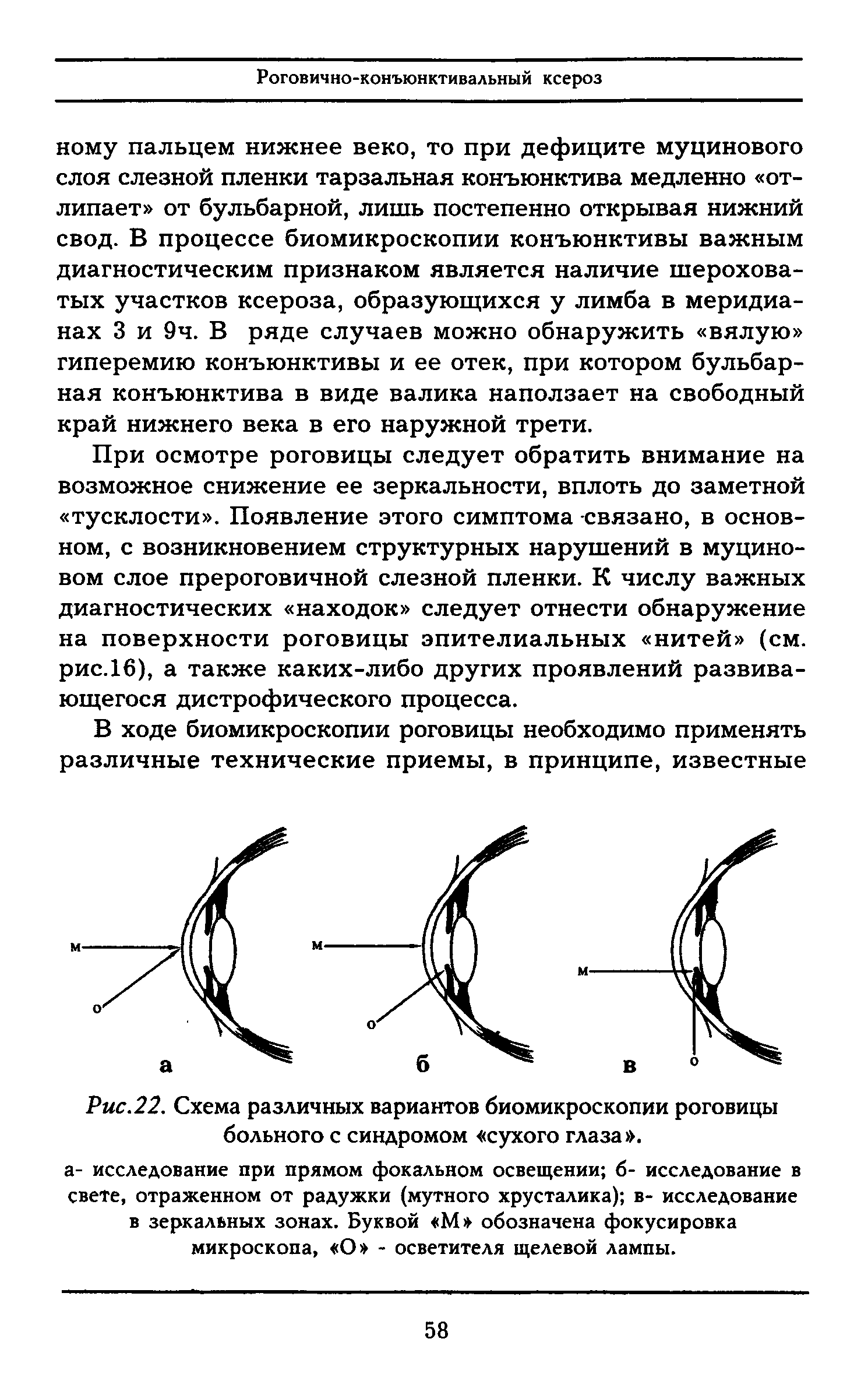 Рис.22. Схема различных вариантов биомикроскопии роговицы больного с синдромом сухого глаза .