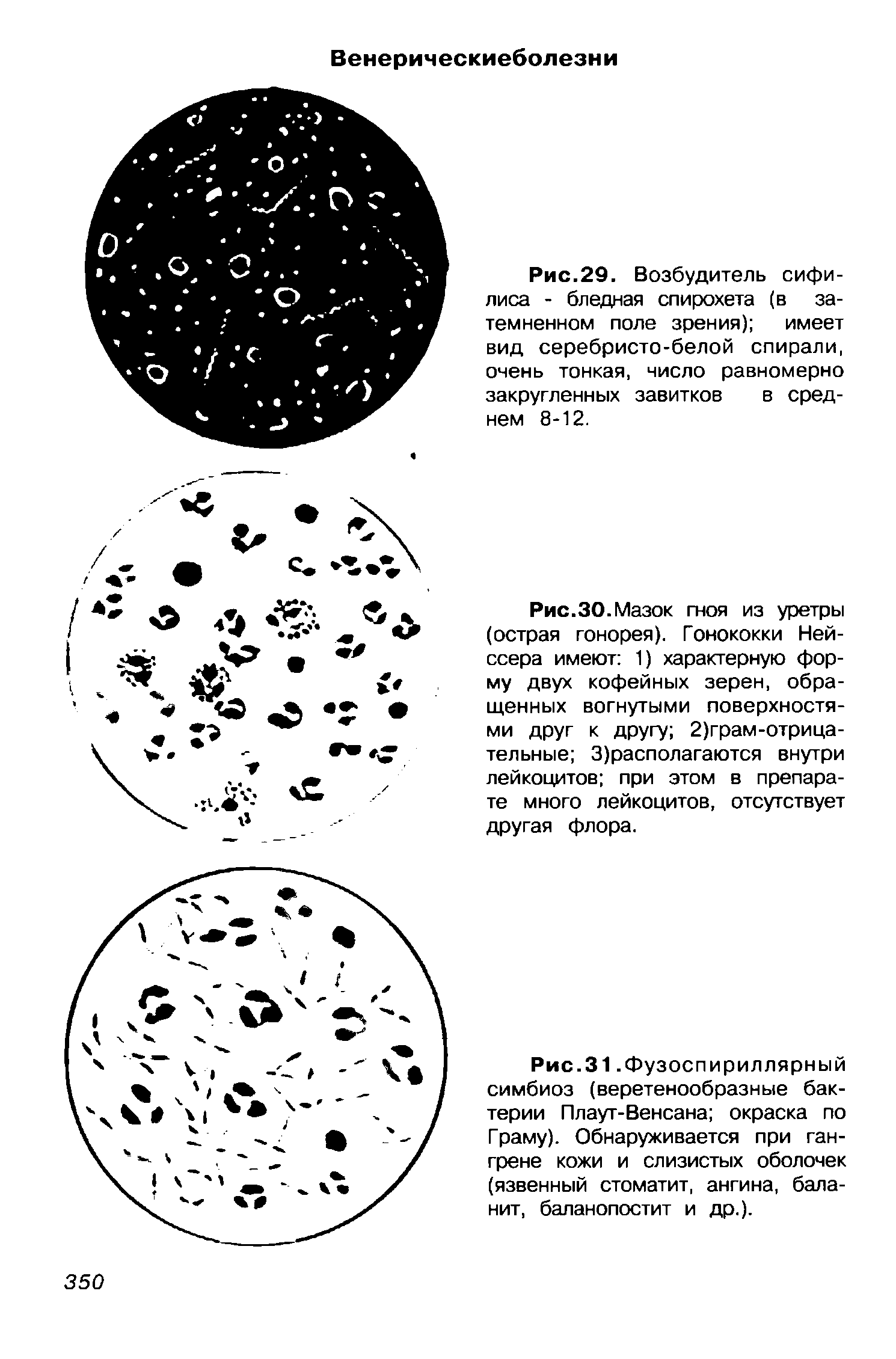 Рис.30.Мазок гноя из уретры (острая гонорея). Гонококки Ней-ссера имеют 1) характерную форму двух кофейных зерен, обращенных вогнутыми поверхностями друг к другу 2)грам-отрица-тельные 3)располагаются внутри лейкоцитов при этом в препарате много лейкоцитов, отсутствует другая флора.