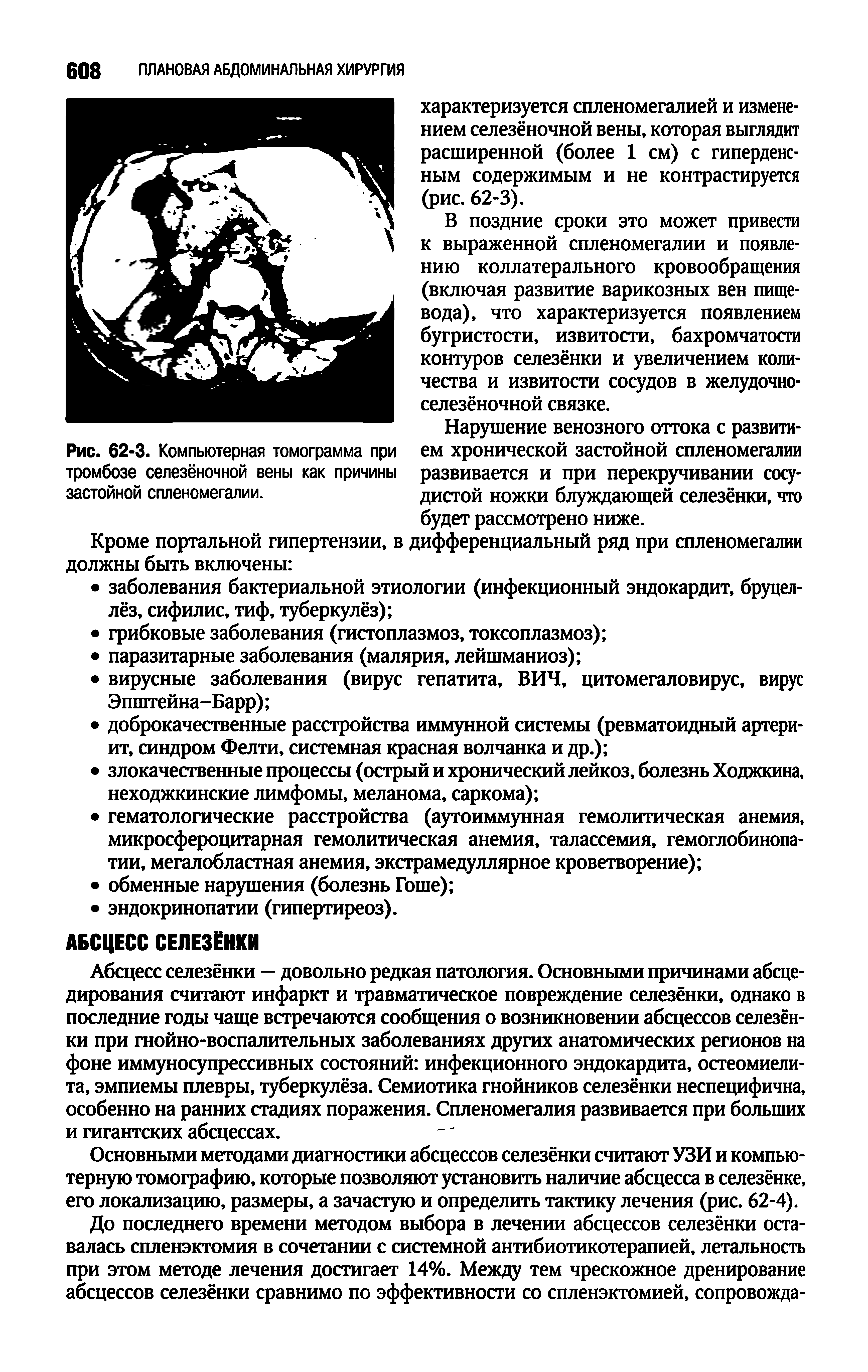 Рис. 62-3. Компьютерная томограмма при тромбозе селезёночной вены как причины застойной спленомегалии.