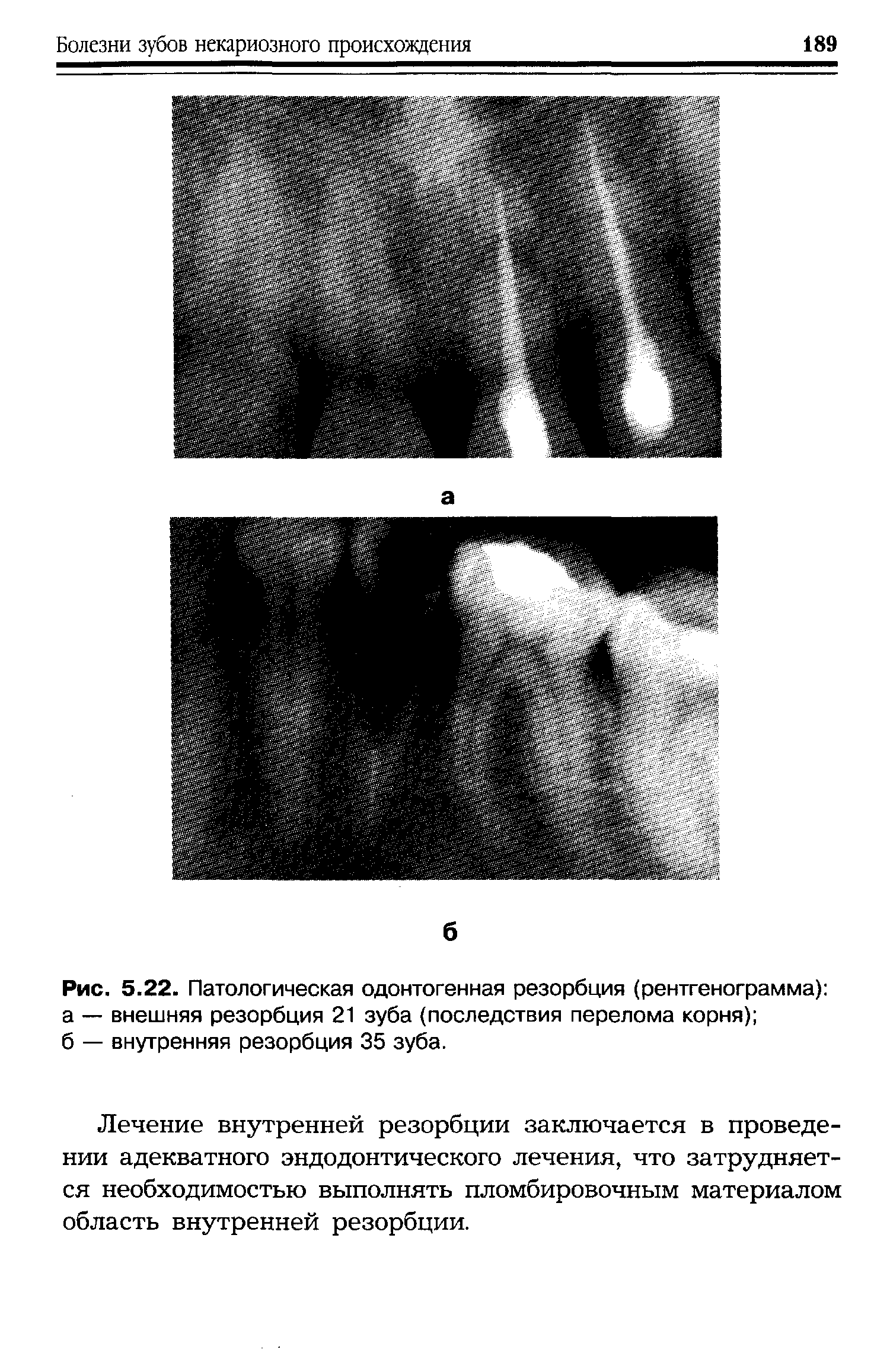 Рис. 5.22. Патологическая одонтогенная резорбция (рентгенограмма) а — внешняя резорбция 21 зуба (последствия перелома корня) ...