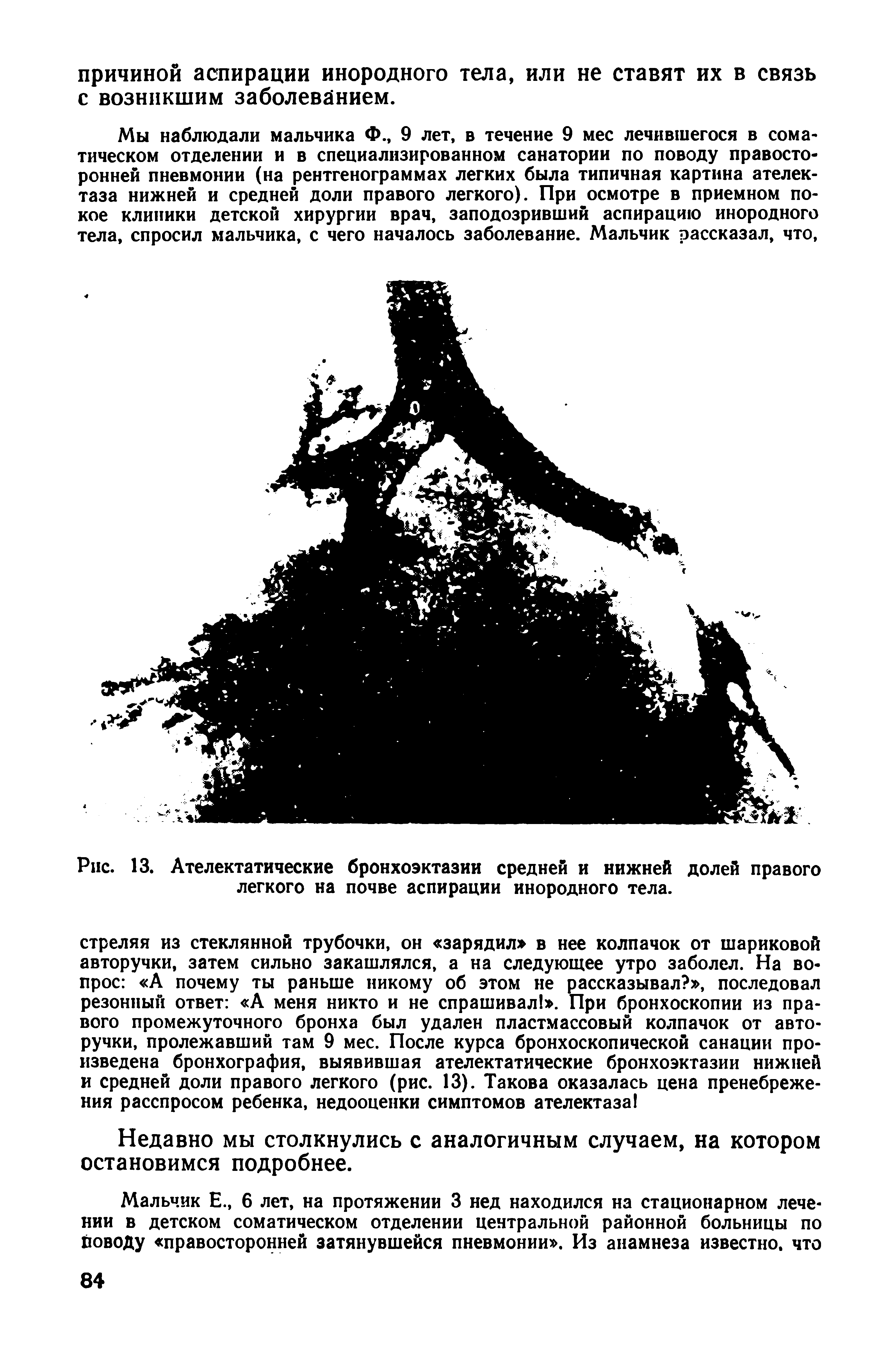 Рис. 13. Ателектатические бронхоэктазии средней и нижней долей правого легкого на почве аспирации инородного тела.