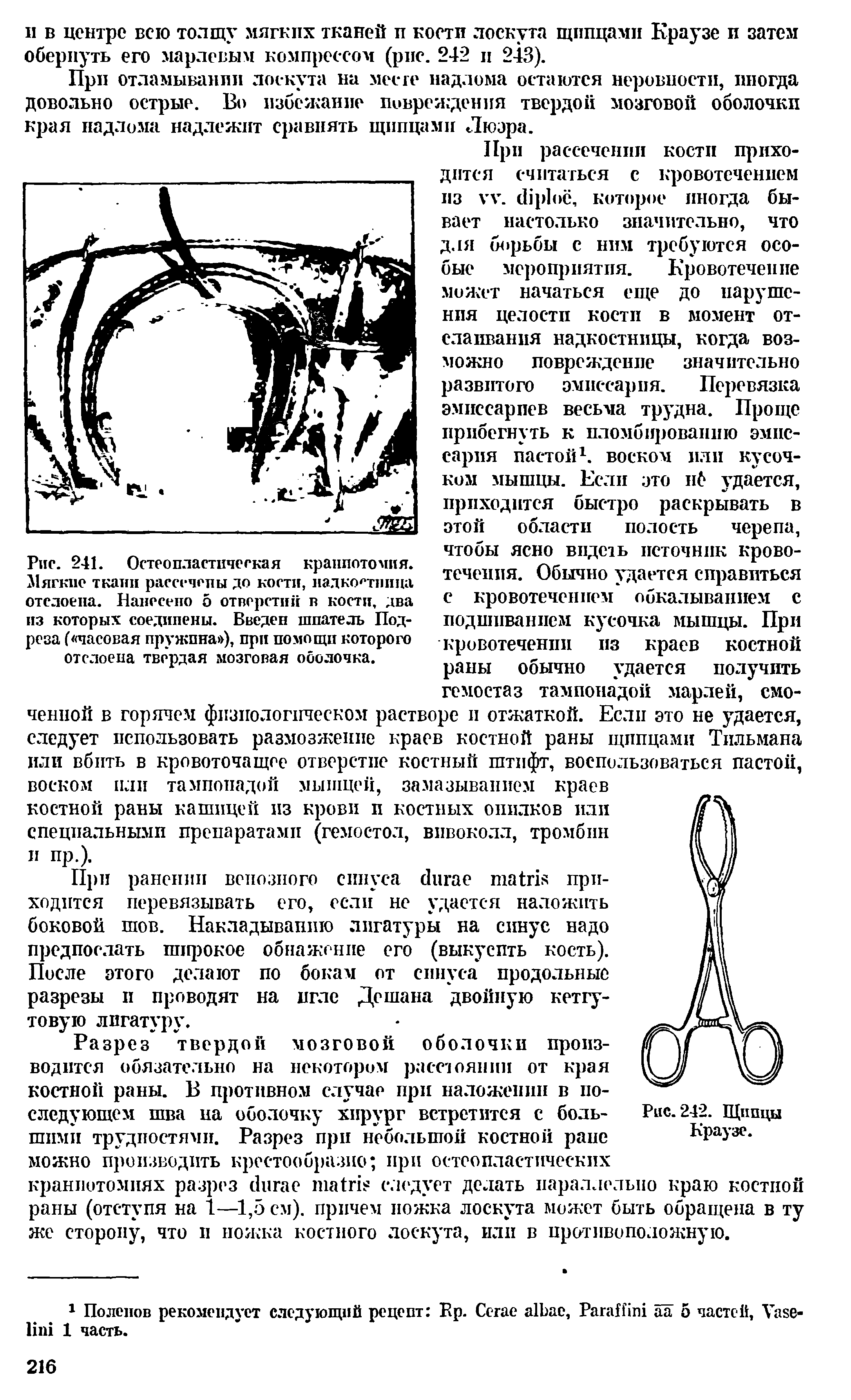 Рис. 241. Остеопластическая краниотомия. Мягкие ткани рассечены до кости, надкостница отслоена. Нанесено о отверстий в кости, два из которых соединены. Введен шпатель Подреза ( часовая пружина ), при помощи которого отслоена твердая мозговая оболочка.